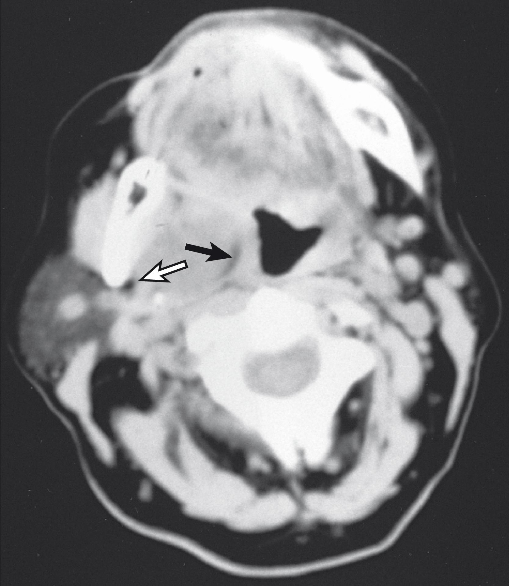 Fig. 69.5, Computed tomography scan demonstrating a pleomorphic adenoma arising de novo in the prestyloid parapharyngeal space. The tumor displaces adipose tissue medially (closed arrow). An adipose tissue plane separates the tumor from the parotid gland (open arrow).