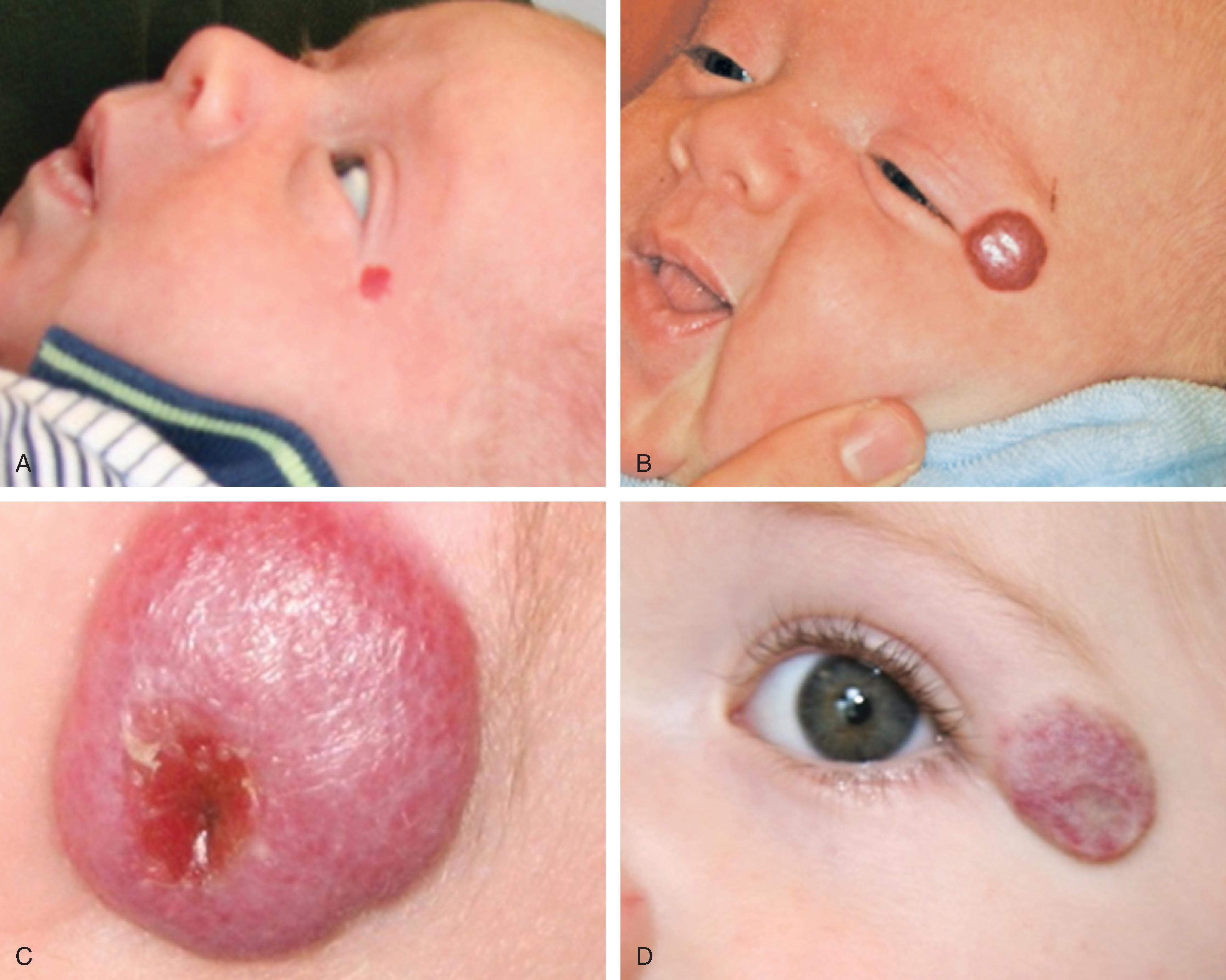 Fig. 28.1, A–D , Natural history of focal superficial infantile hemangioma through proliferation, ulceration and involution with residuum.