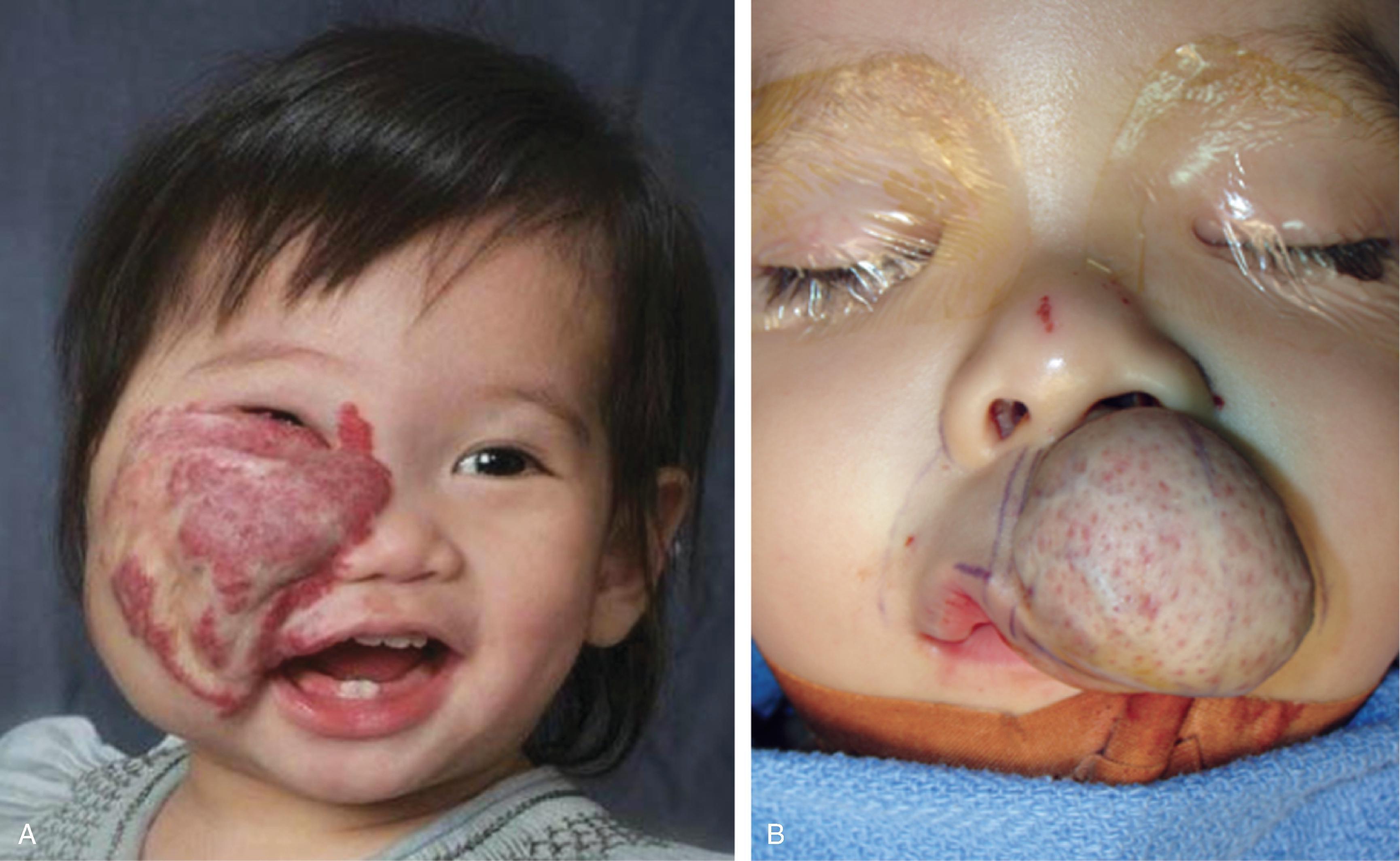 FIG. 28.2, Examples of involuting segmental ( A ) and fully involuted focal ( B ) infantile hemangiomas. Note the residual telangiectasias, anetoderma, fibrofatty residual mass effect, and textural changes.