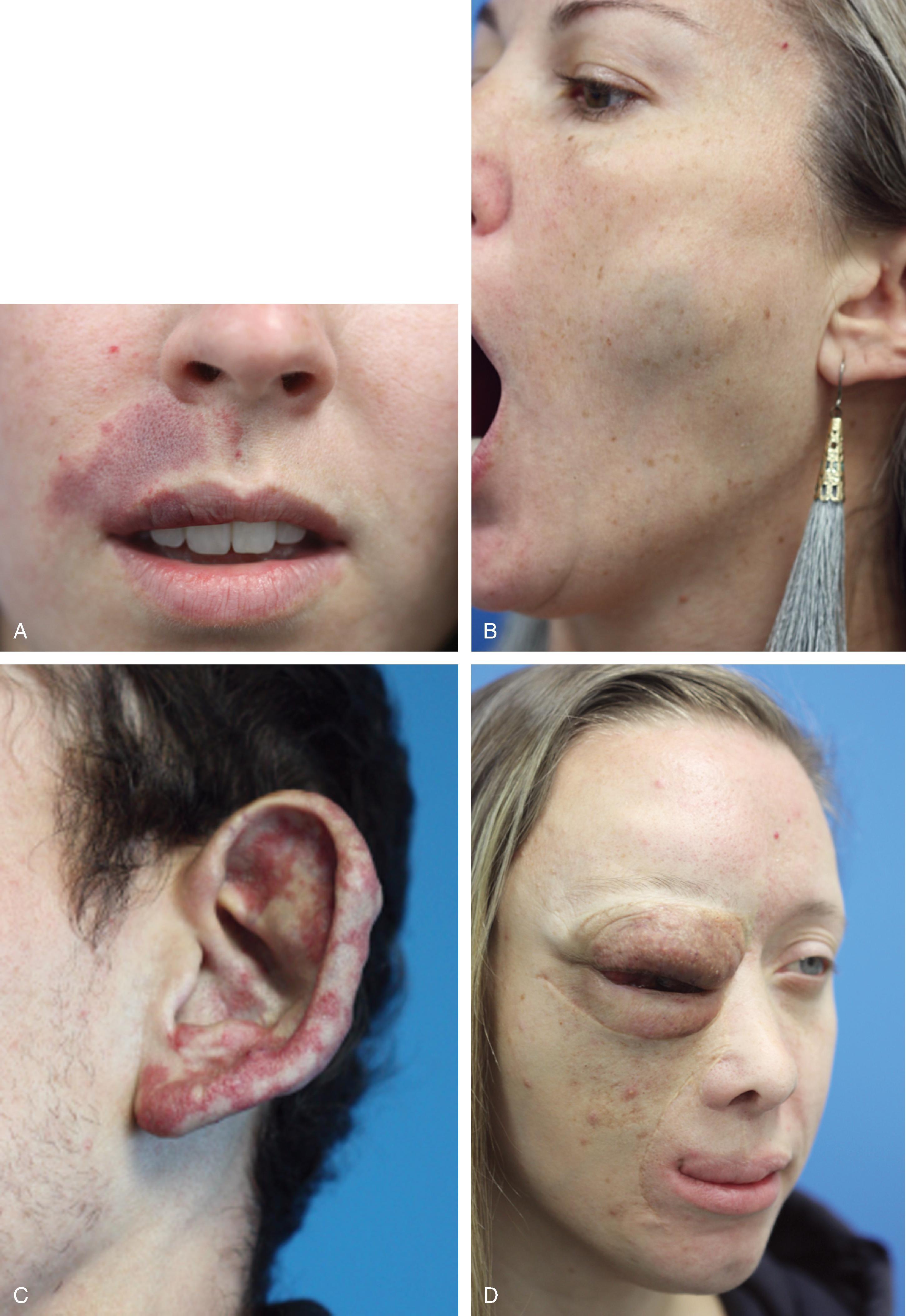 FIG. 28.3, Examples of vascular malformations. A , Capillary/venular malformation (port-wine stain). B , Venous malformation. C , Arterio-venous malformation. D , Lymphatic malformation.