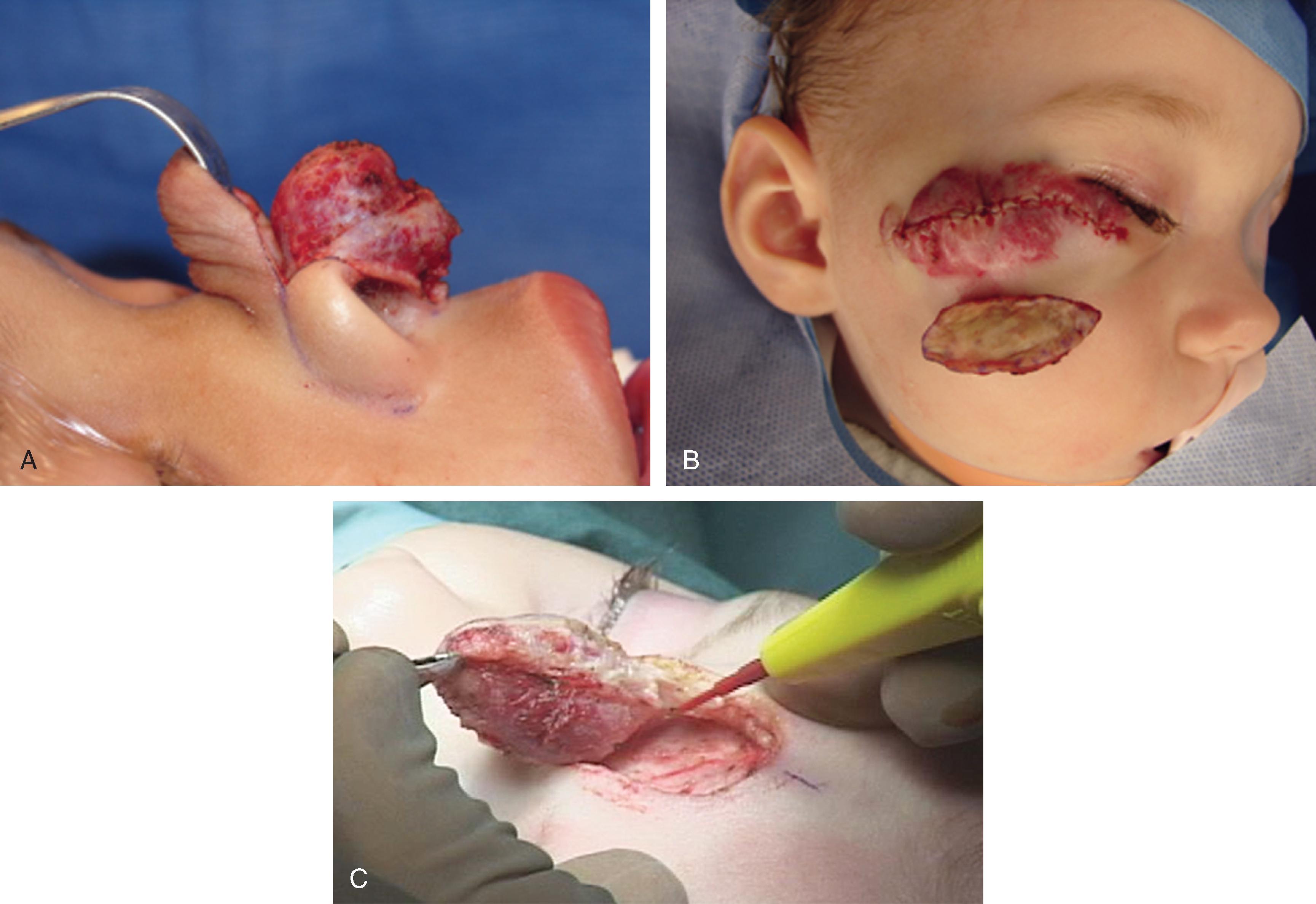 FIG. 28.4, Surgical planes can be developed between the superficial and deep component ( A ), within the deep component (intralesional; B ) or between the deep component of an infantile hemangioma and normal tissue ( C ).