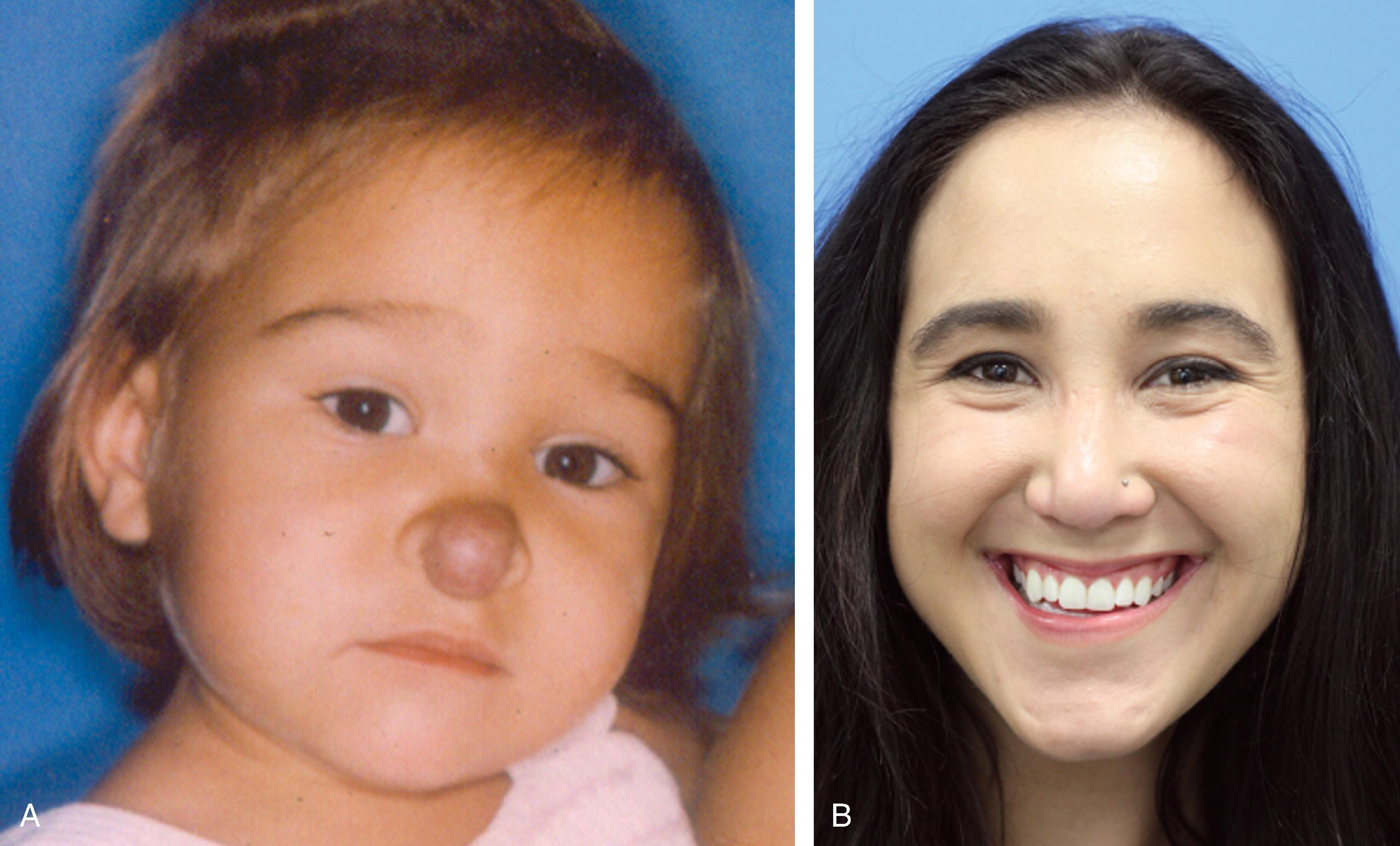 FIG. 28.5, Involuting compound infantile hemangioma before ( A ) and 20 years after ( B ) surgical excision of deep component and pulsed dye laser treatment of residual superficial component.