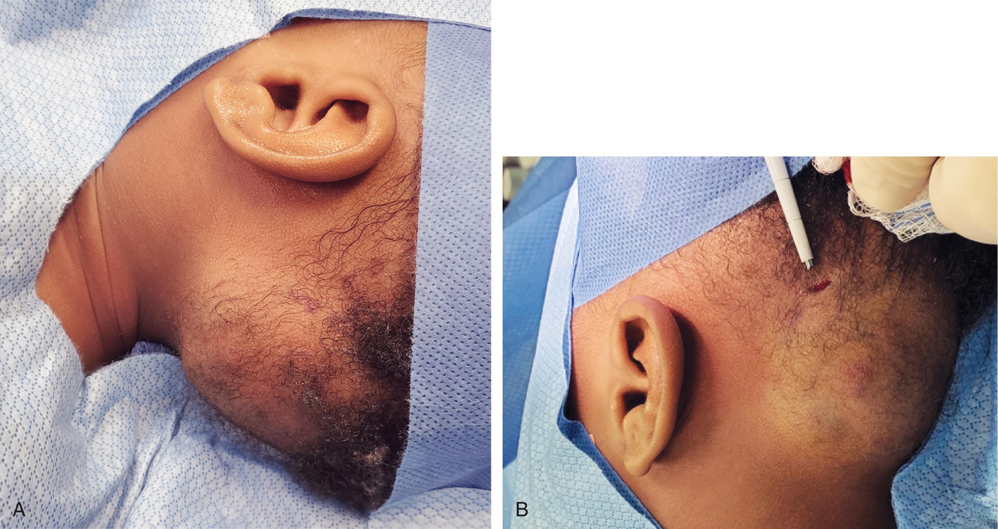 FIG. 28.6, Deep infantile hemangioma of the scalp being debulked with ultrasonic aspirator via minimal incision.