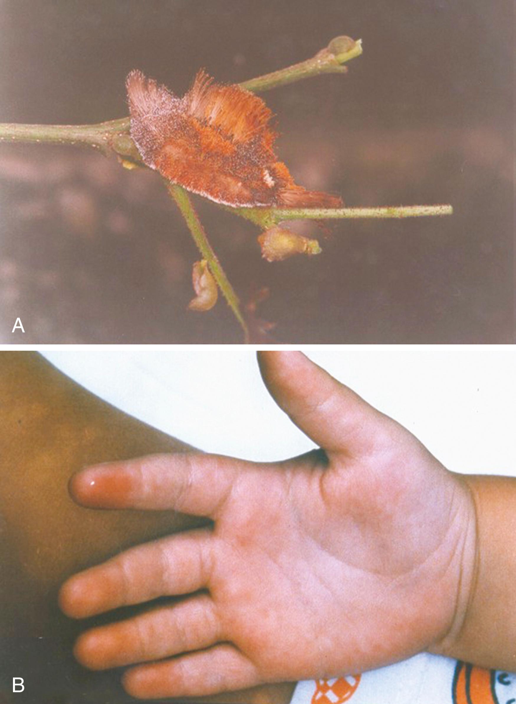 Fig. 52.1, Caterpillar of the Megalopygidae family (A) and injuries in a child (B) . The pain was intense, but local inflammation was discrete.