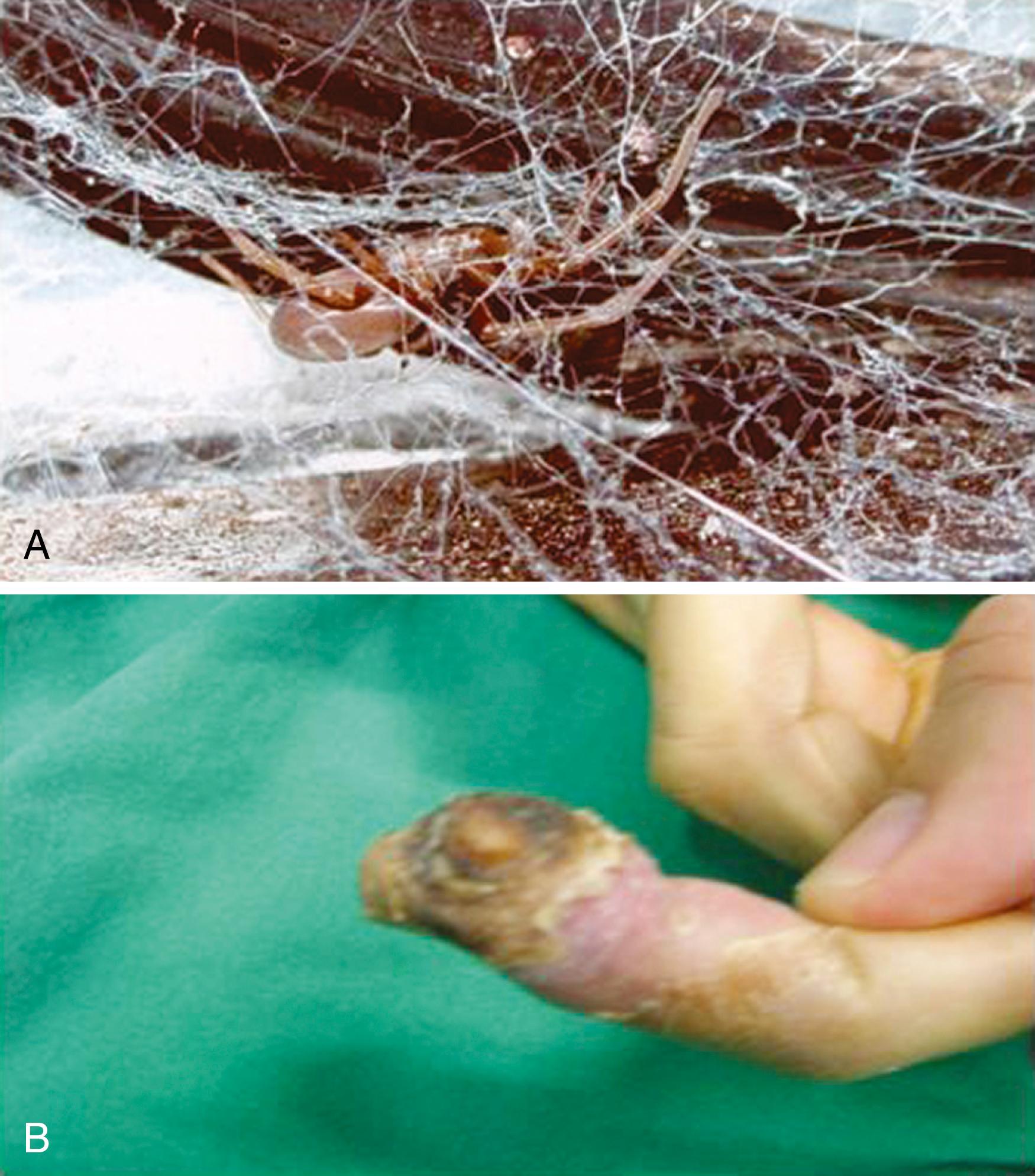 Fig. 52.2, A, Loxosceles, the brown recluse spider. B, The venom of this spider has a potent necrotic effect. Considerable necrosis occurred in the fifth finger of a woman after a brown spider bite (she saw the spider).