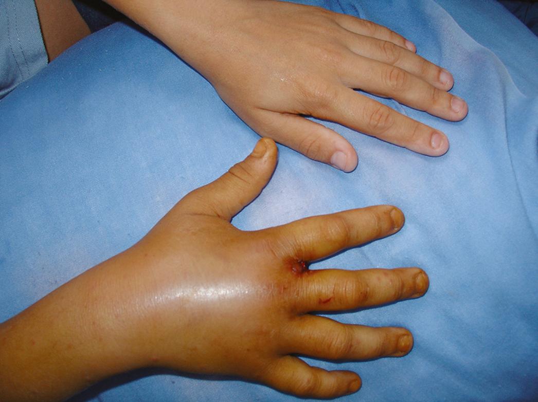 Fig. 52.4, Edema and erythema are the early signs after the bite of a Viperidae snake. The edema is sometimes so pronounced that it causes compression and ischemia in hand structures.