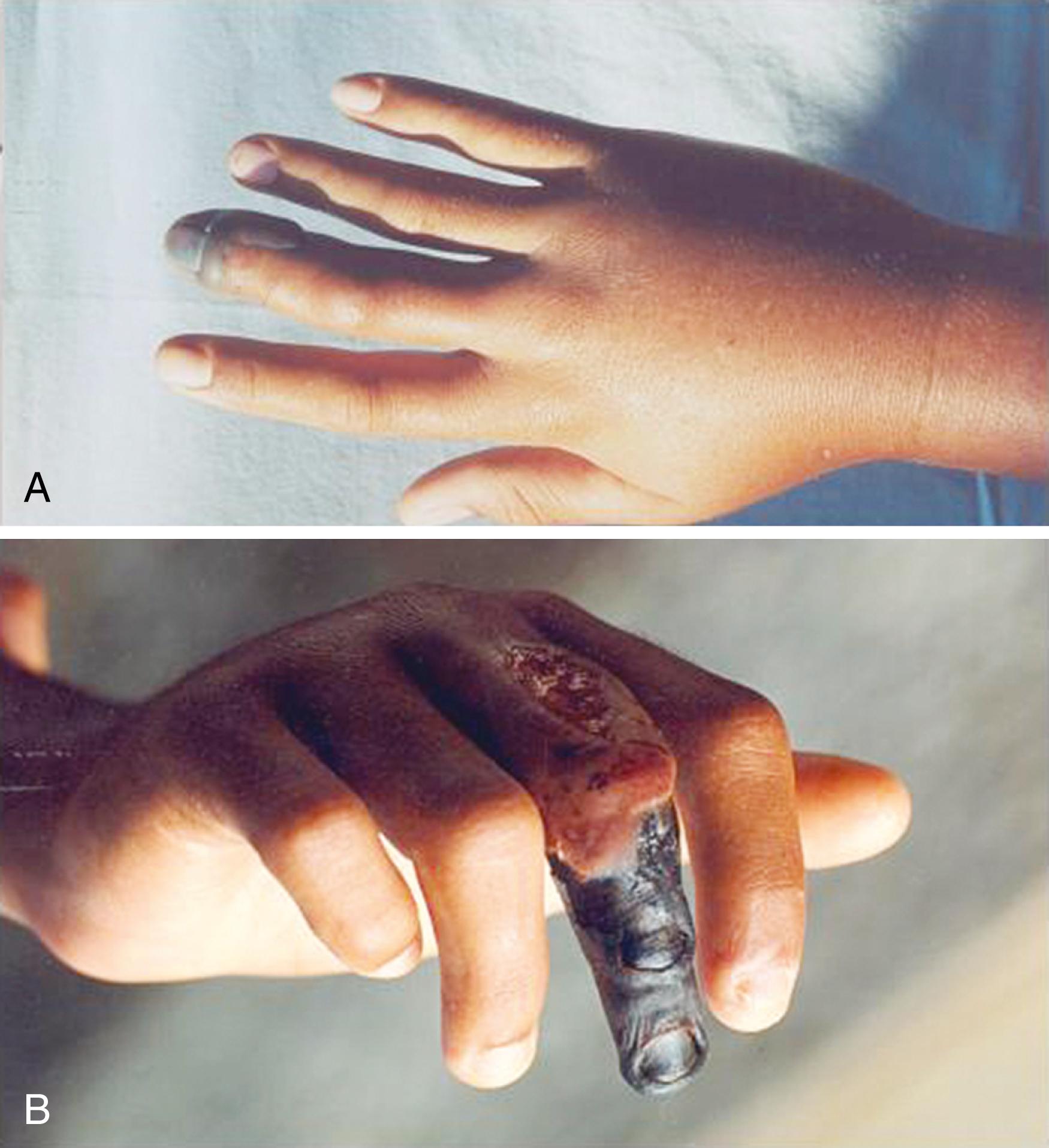 Fig. 52.5, A, Hemorrhagic bullae and edema with necrosis are common complications of Viperidae bites. The ischemia and necrosis can be severe. B, Snakebites in the extremities are potentially severe because of their terminal circulation. Necrosis and amputation of the fingers can occur, especially in patients who do not begin treatment soon enough.