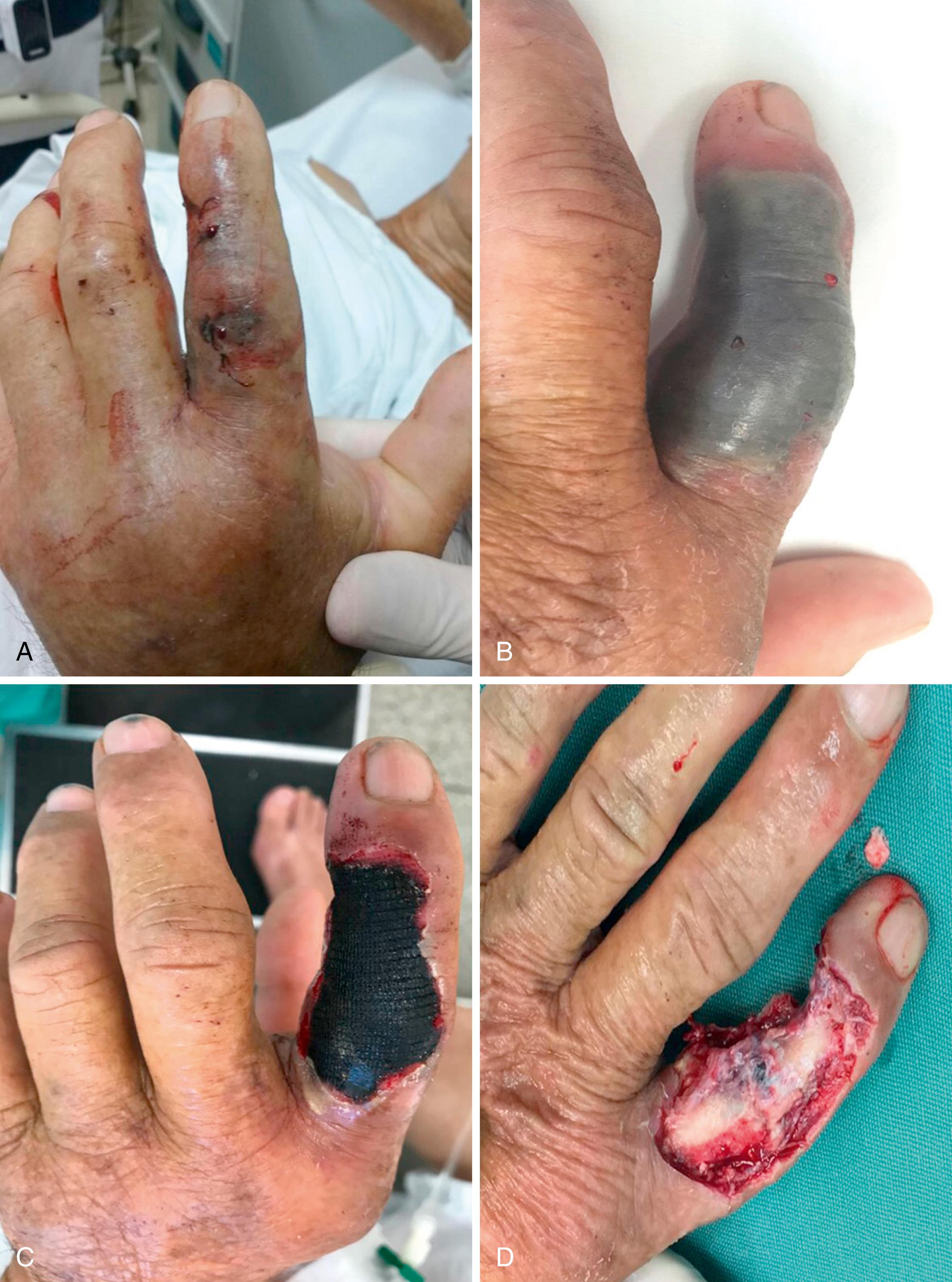 Fig. 52.7, A, Patient who was bitten by a Bothrops snake on the index finger with approximately 6 hours of evolution is already showing the beginning of tissue necrosis when treatment with antivenom serum was started. B, Aspect of the finger with 24 hours after the bite. C, Intense tissue necrosis 7 days after the bite and treatment with the antivenom serum. D, Finger after surgical debridement. Due to severe tissue loss, we opted for amputation of the II digital ray.