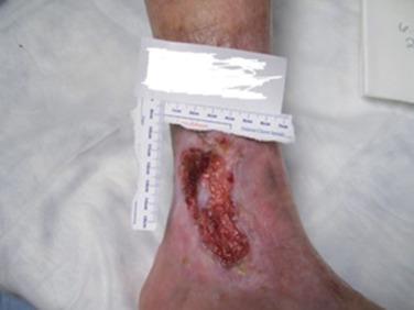 FIG 54.2, A photo of a typical appearing venous ulcer of the ankle can be useful for both initial measurements and determining healing rate.