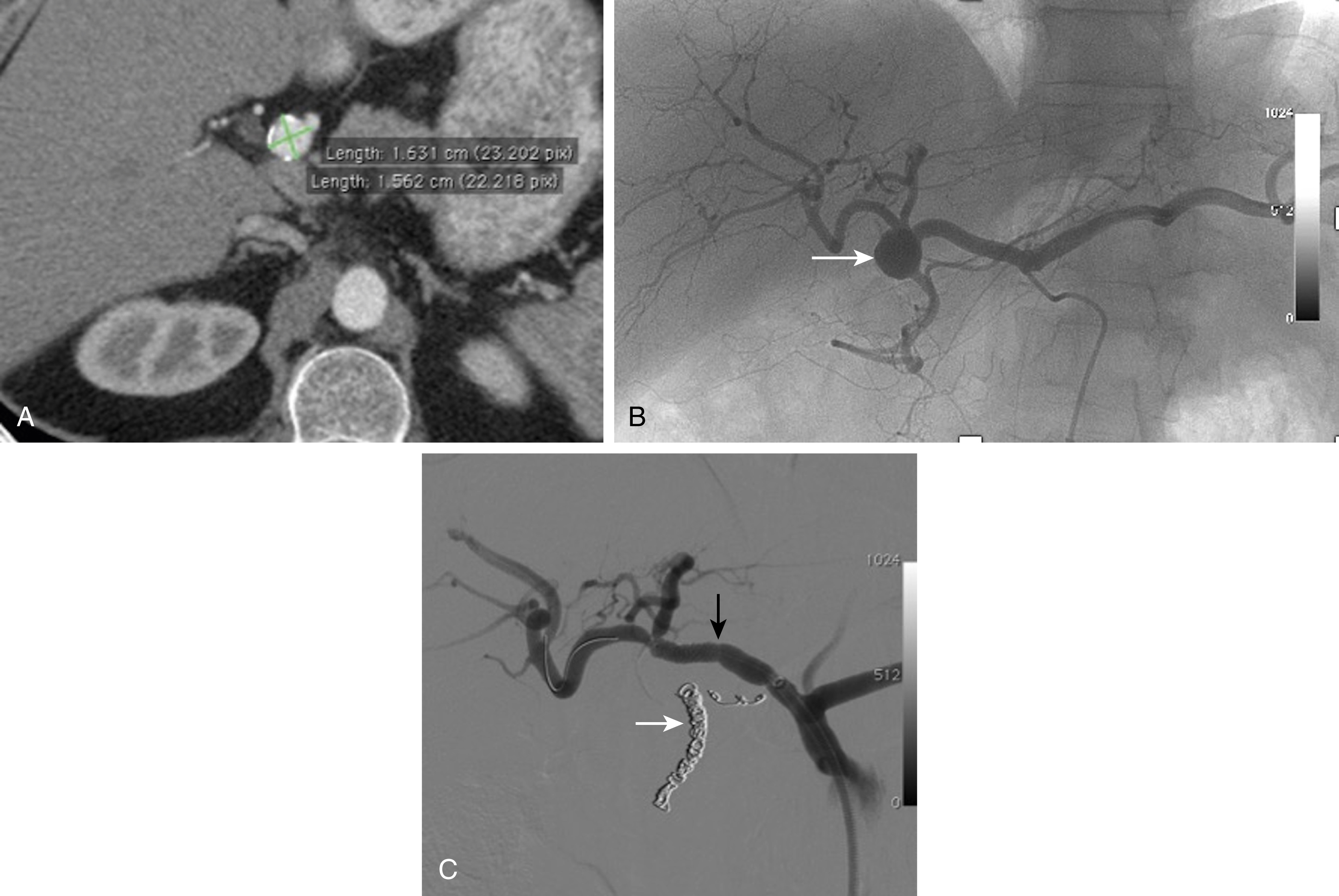 Fig. 41.1, Common hepatic artery aneurysm in an asymptomatic patient. (A) Axial computed tomography scan demonstrates an aneurysm of the distal part of the common hepatic artery, with mural calcification. (B) Selective hepatic arteriography confirms the aneurysm of the common hepatic artery, in front of the gastroduodenal artery (GDA) ( arrow ). Note that the proper hepatic artery is very short. (C) Control film after placement of a coronary covered stent across the neck of the aneurysm involving the hepatic artery ( black arrow ), preserving the left hepatic artery. Coil embolization of the GDA was performed before stent placement to avoid any retrograde revascularization of the sac ( white arrow ). Note that the aneurysm is completely excluded while patency of the parent vessel is maintained.