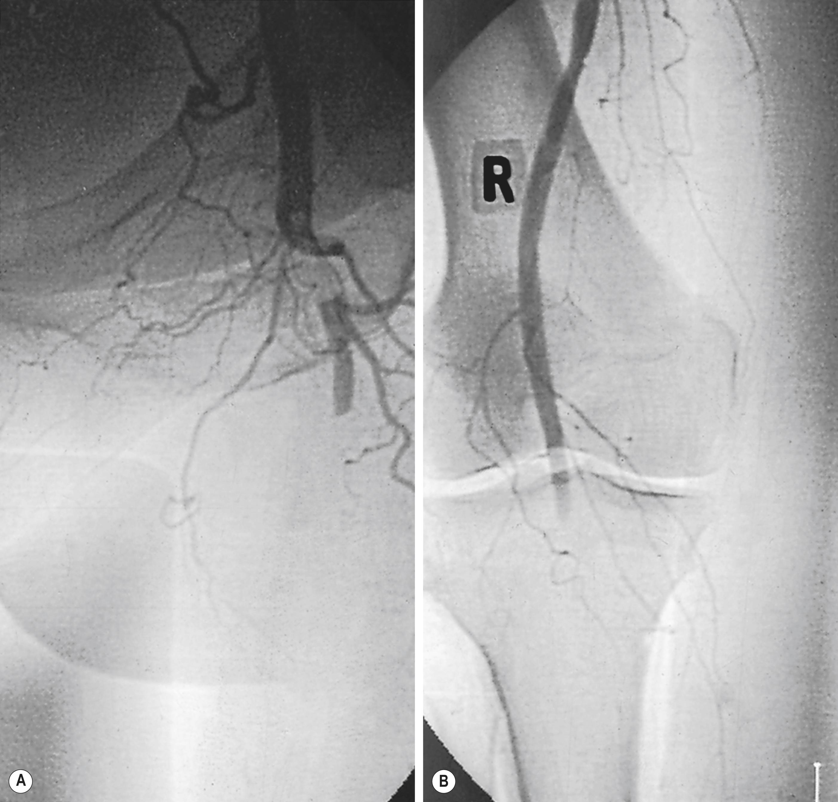 Figure 8.1, Arteriogram demonstrating an embolus lodged in the bifurcation of the common femoral artery (a) with further emboli occluding the distal profunda and popliteal artery (b).