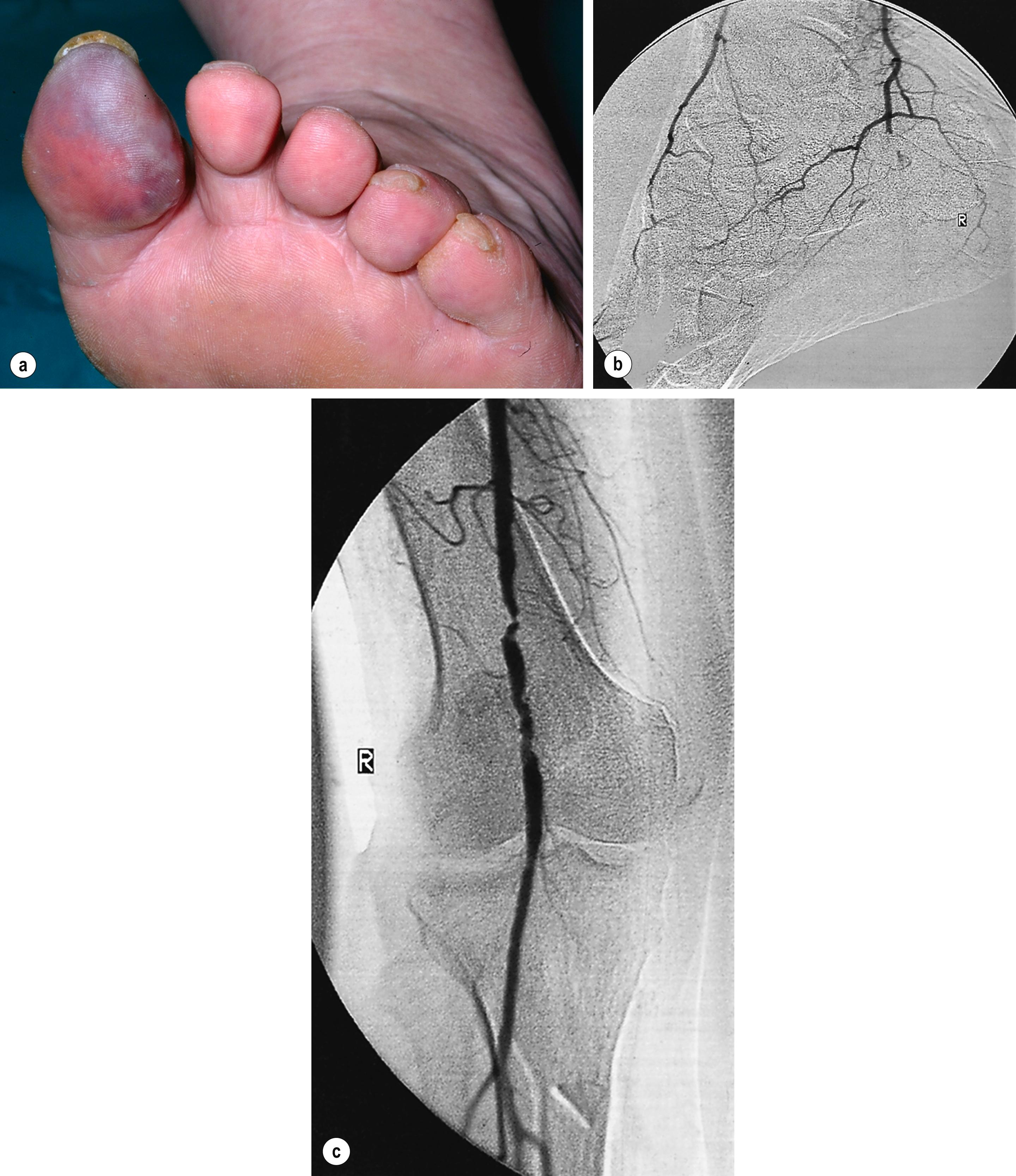 Figure 8.2, (a) ‘Blue toe syndrome’ caused by digital and pedal arterial atheroembolism (b) from a proximal atherosclerotic stenosis (c). Note the acute cut-off of the posterior tibial artery. Ultrasonography excluded a popliteal aneurysm, and the lesion was treated by balloon angioplasty.