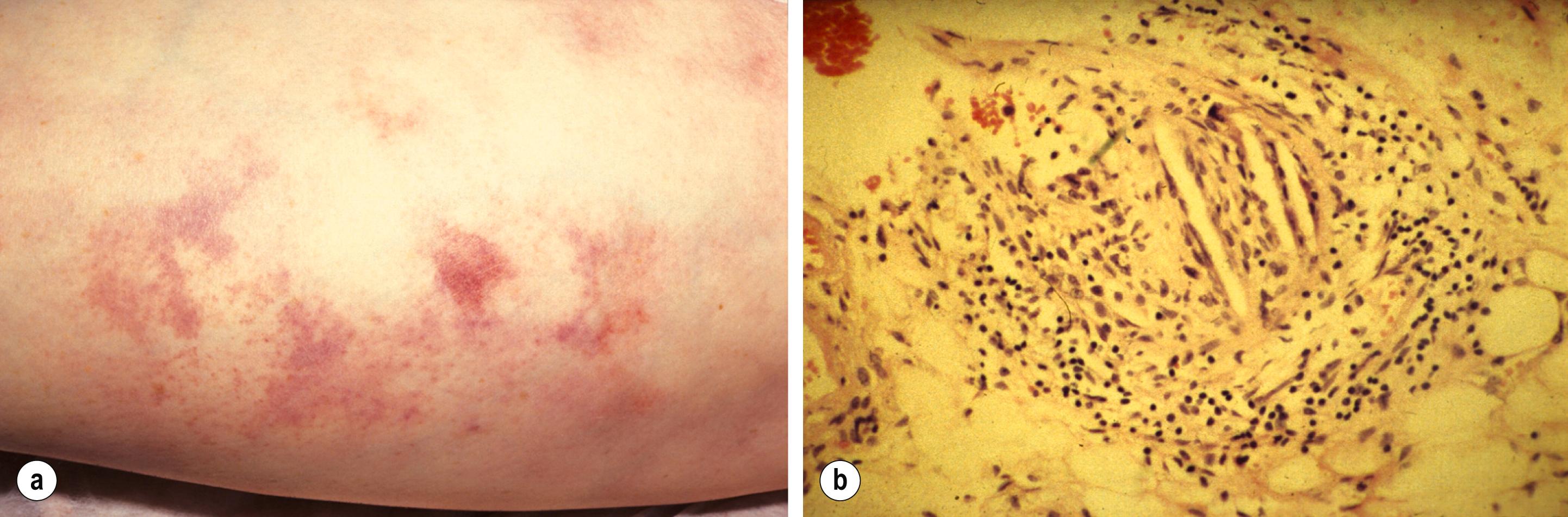 Figure 8.3, Livedo reticularis (a) caused by cholesterol embolism (b).