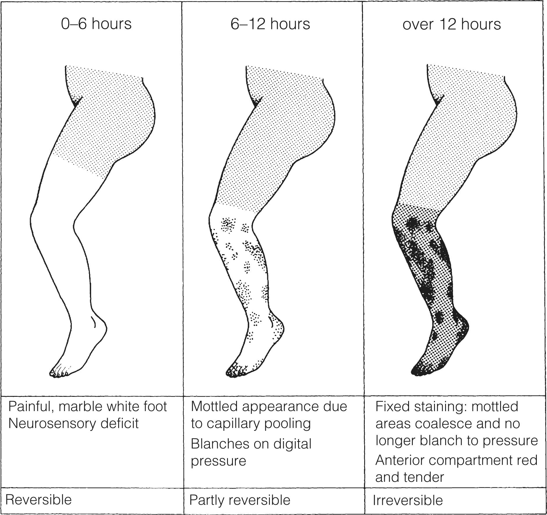 Figure 8.4, Clinical outcome after acute leg ischaemia.