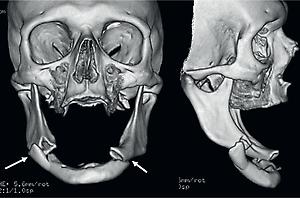 Figure 1.2, This edentulous 73-year-old patient sustained bilateral mandibular body fractures following a fall. The displacement of the anterior mandibular segment posteriorly resulted in airway embarrassment, necessitating urgent intubation.