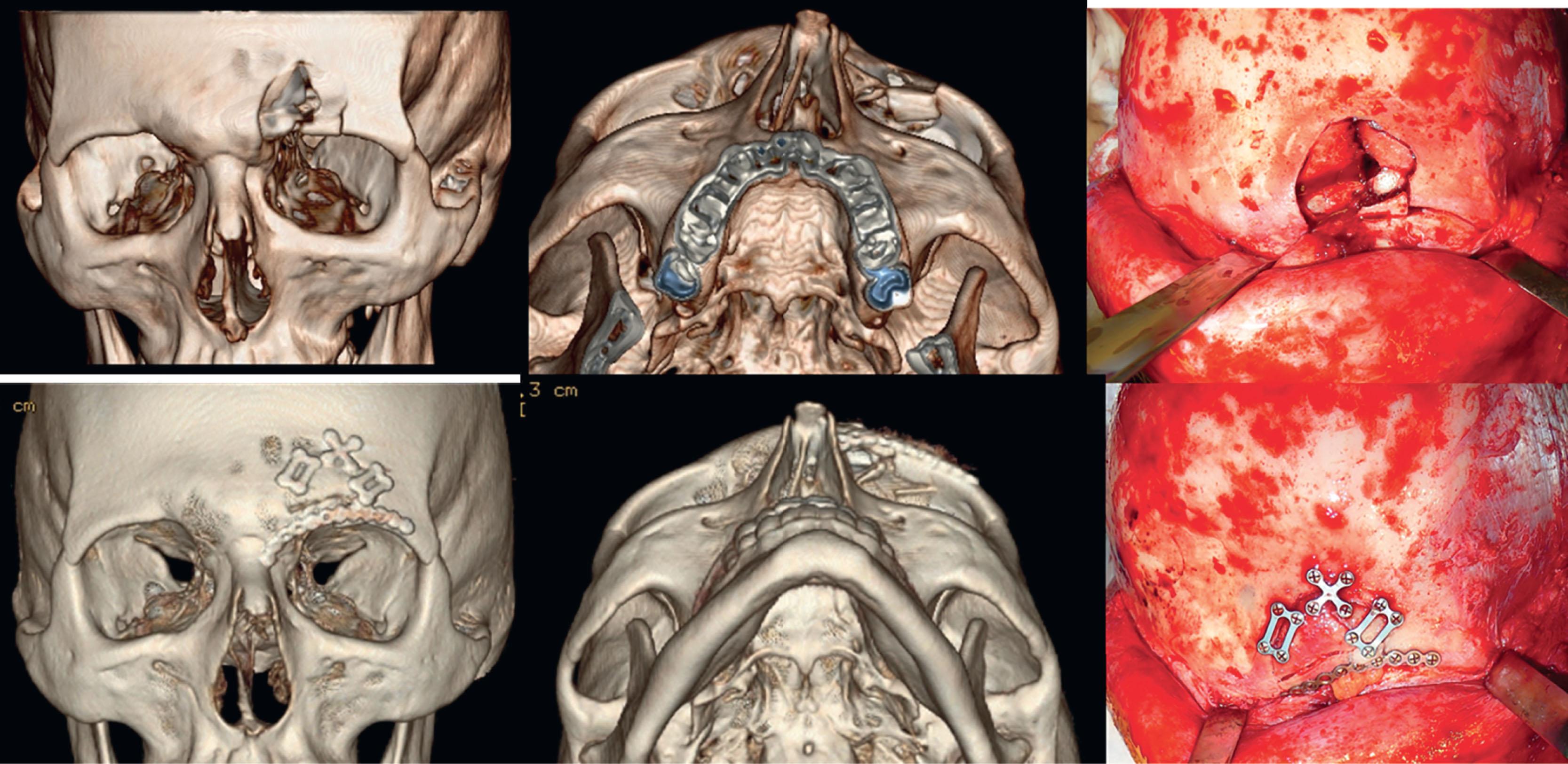 Figure 1.13, This patient sustained an isolated fracture of the anterior table of the left frontal sinus, without obstruction of the nasofrontal outflow tract. Treatment consisted of open reduction and internal fixation via a coronal approach. Pre- (top row) and post-reduction (bottom row) images are shown.