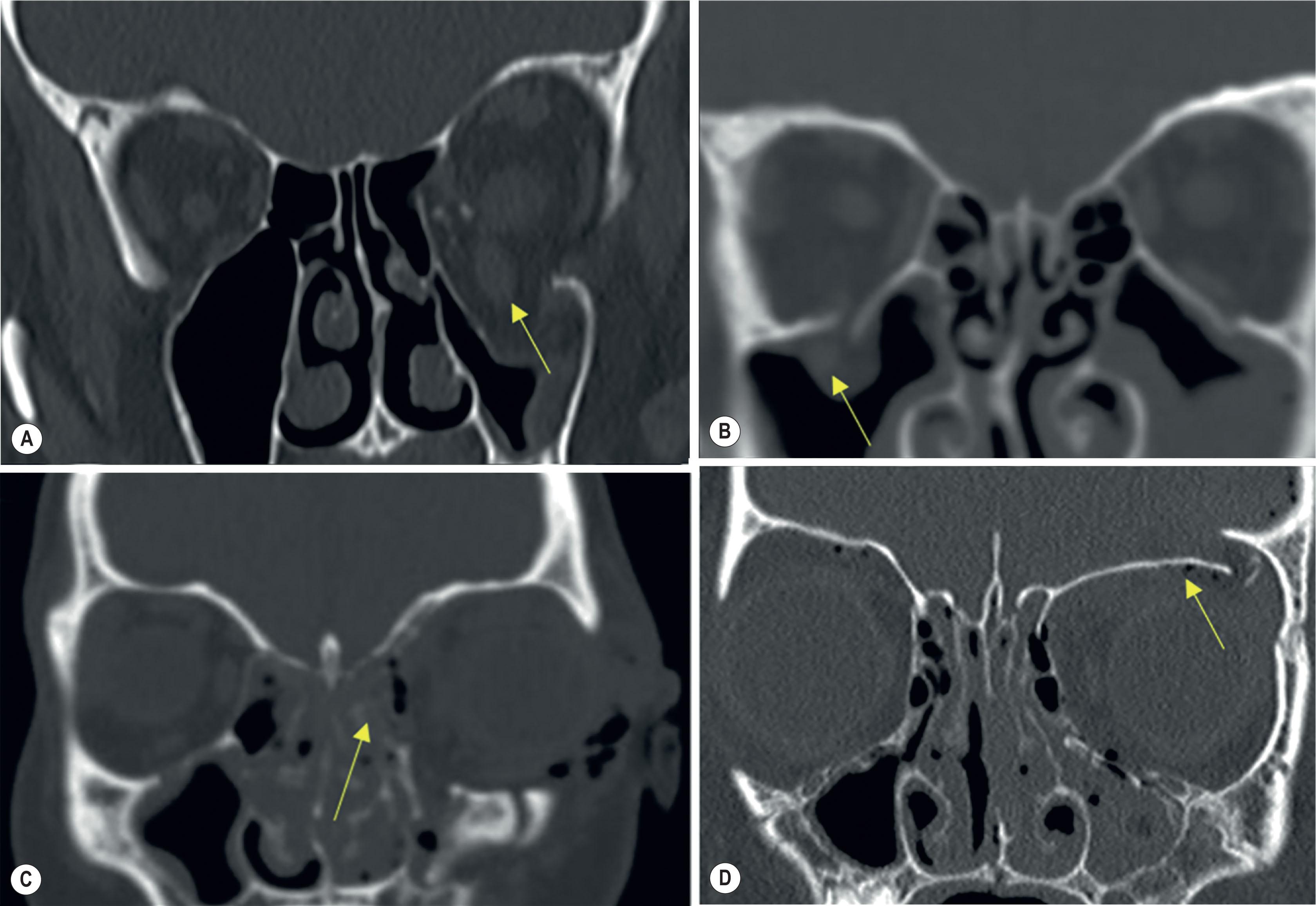 Figure 1.16, Different patterns of orbital injury. (A) Left orbital floor “blow-out” fracture with herniation of periorbital soft tissue in the left maxillary sinus (arrow). (B) Left orbital floor “trapdoor” fracture with entrapment of the inferior rectus muscle (arrow) below the seemingly intact orbital floor. (C) Left medial orbital wall fracture with herniation of medial orbital soft tissue into the ethmoid sinus. (D) Left orbital roof “blow-in” fracture resulting in decreased orbital volume.