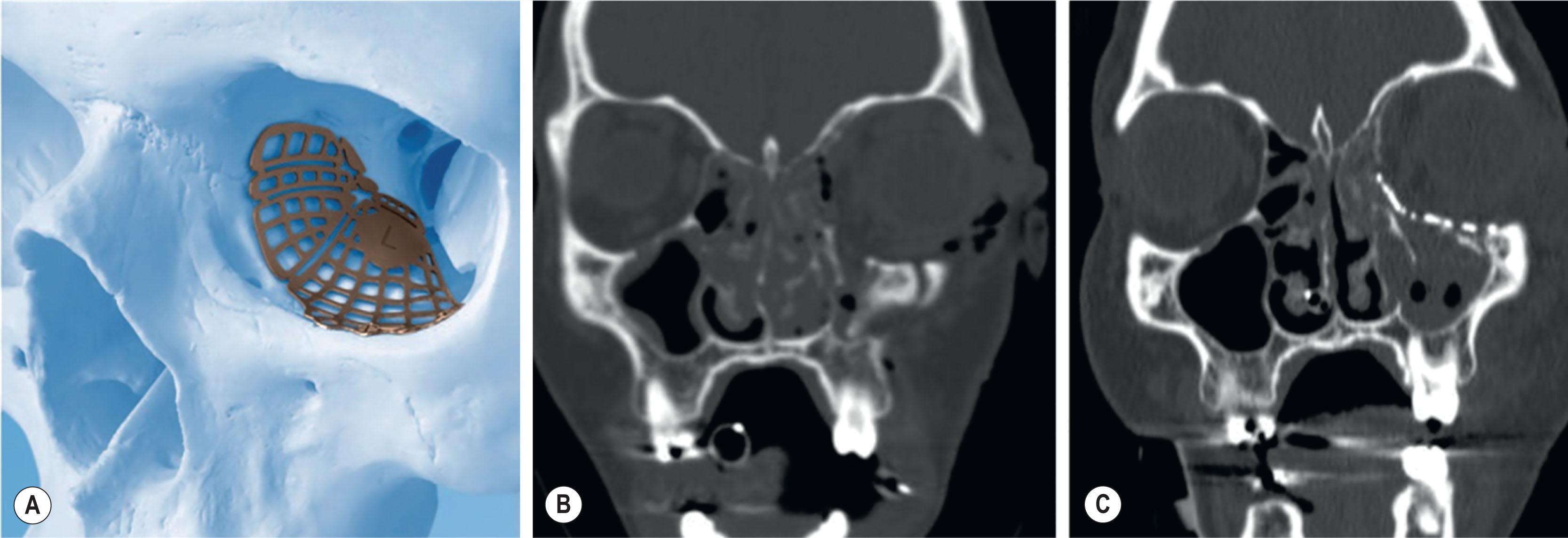 Figure 1.18, Computer-designed 3D anatomic implants for orbital reconstruction (A) are helpful for reconstituting orbital anatomy when multiple contiguous orbital walls are injured, such as in this patient with combined medial wall and floor fractures (B,C) .