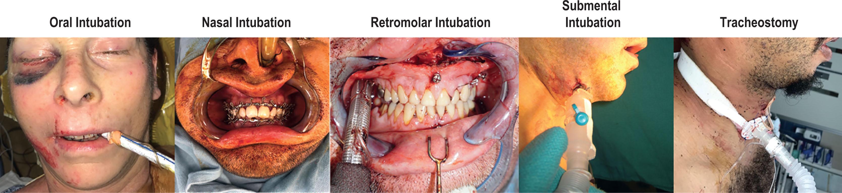 Figure 1.3, There are a number of methods for airway management in patients with craniomaxillofacial injuries. Oral intubation is useful in instances where intermaxillary fixation may not be needed. In patients where intermaxillary fixation is necessary or there is need to repair tongue or floor of mouth soft-tissue injuries, a nasal intubation is preferred. In patients where intermaxillary fixation is necessary, but intranasal work also needs to be completed, oral intubation with the endotracheal tube routed in the retromolar space or a submental intubation can be used. Many patients with multisystem injuries may require a tracheostomy for prolonged ventilatory support.