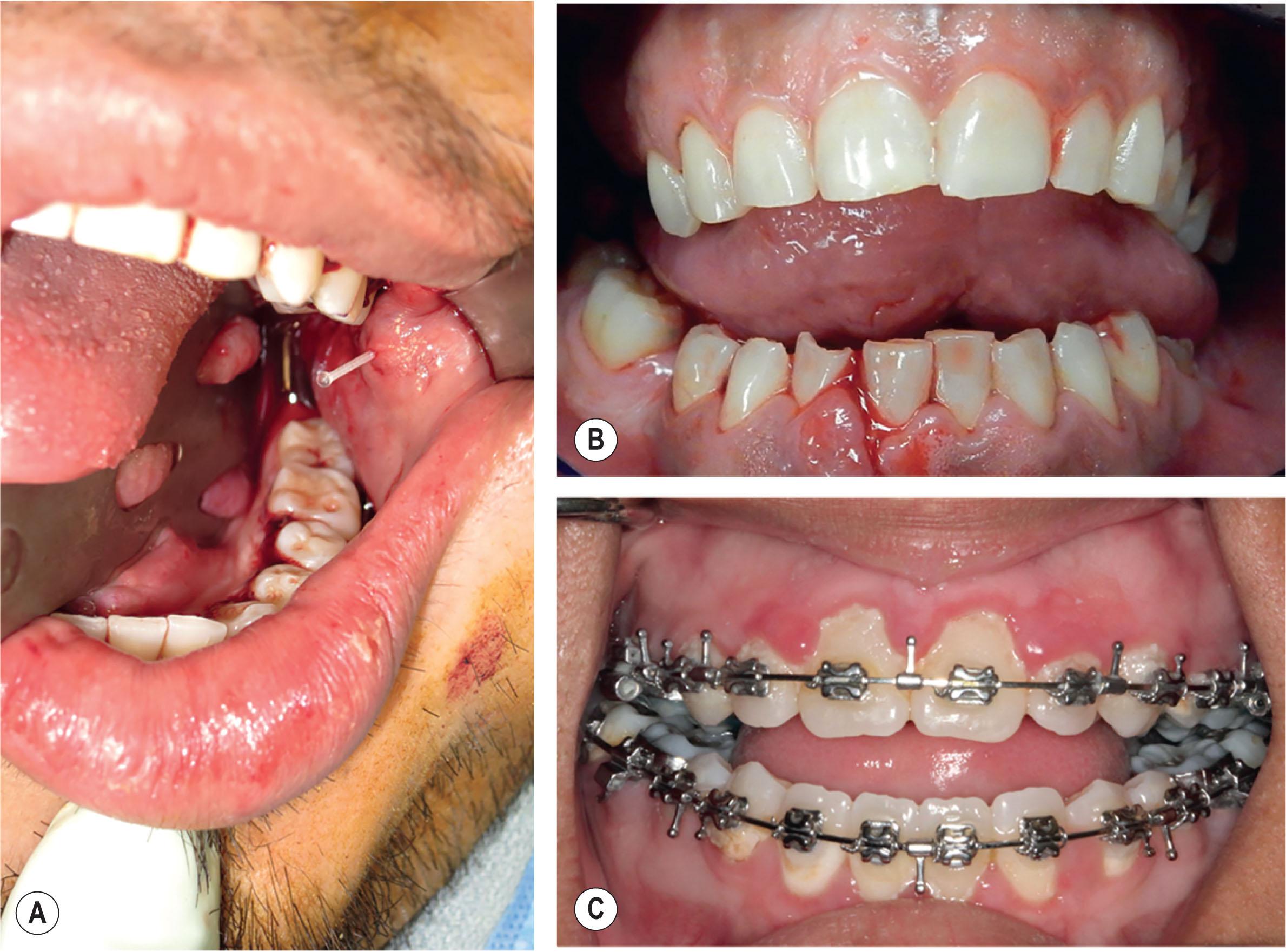 Figure 1.6, Intraoral examination remains a critical component of the craniomaxillofacial assessment. (A) In this patient with a large cheek laceration, the parotid duct was cannulated intraorally using a 20-gauge angiocatheter. Palpation of the parotid gland expressed clear salivary flow intraorally, consistent with an intact duct. (B) Wear patterns on the edges of the teeth may provide insights in to the baseline occlusion. (C) The presence of mammelons (curved ridges on the incisal edges) is suggestive of a premorbid anterior open bite, as seen in this orthognathic surgery patient.