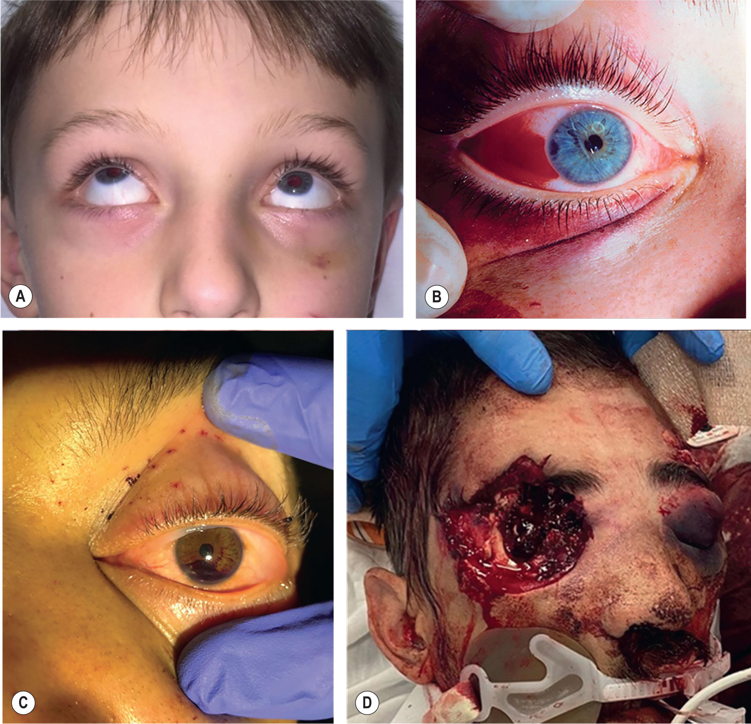 Figure 1.7, Careful examination of the globes is necessary when evaluating patients with facial injuries. (A) This child sustained a blunt force injury to the left orbit, resulting in entrapment of a portion of the inferior rectus and periorbital fat, with associated restriction of globe motion. (B) Subconjunctival/scleral hemorrhage is a common finding in patients with bony injuries affecting the orbital walls. (C) Hyphema, or blood in the anterior chamber of the eye, is an important ocular finding that mandates further assessment by Ophthalmology. High-grade hyphema may be a contraindication to early intervention for orbital fractures. (D) Globe rupture is not infrequently seen with high-energy orbital injuries.