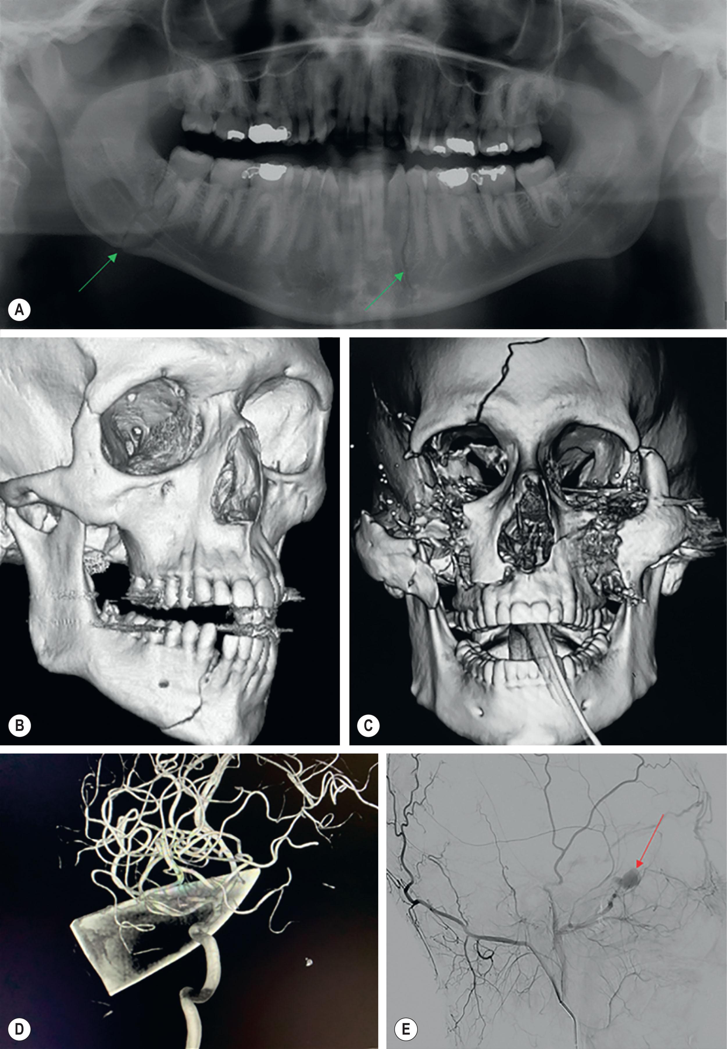 Figure 1.8, Multiple modalities are available for radiographic assessment of the patient with facial injury. Plain film images, such as the panoramic radiograph (A) , may be useful for identifying mandibular fractures (arrows). Three-dimensional imaging modalities are useful for comprehensive visualization of both simple (B) and complex (C) craniomaxillofacial injuries. CT angiography can demonstrate the relationship between major vessels and the area of injury, including foreign bodies, such as this patient who sustained a penetrating injury (D) . Formal angiography is a useful adjunct in patients with intractable hemorrhage after facial injury (E) , such as this patient with pseudoaneurysm of the internal maxillary artery (arrow) following a Le Fort fracture.