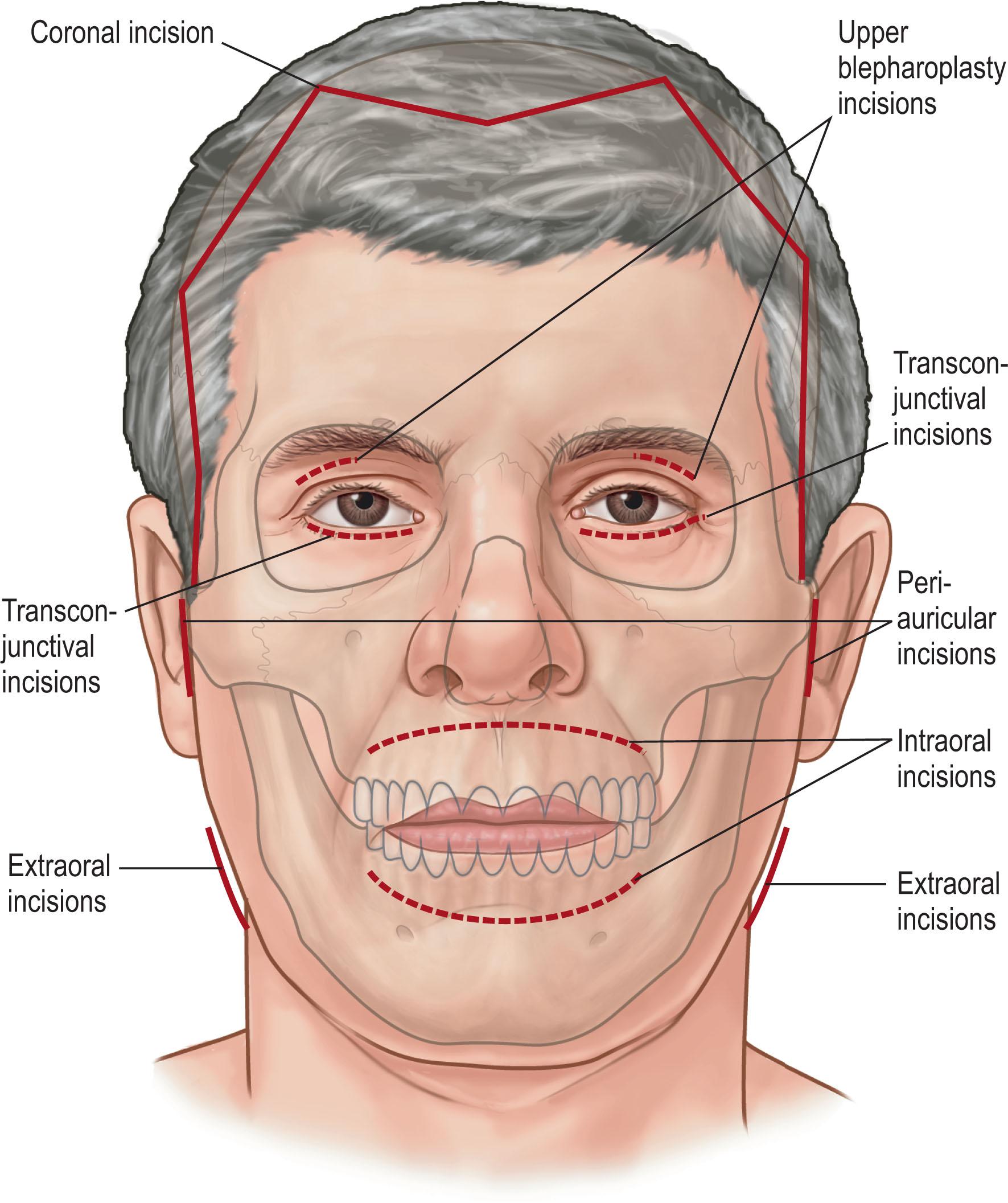 Figure 1.9, Various options for accessing the facial skeleton are shown here. The choice of any particular approach is predicated on a balance between affording appropriate exposure to the area of interest and avoiding unfavorable scarring or nerve injury.