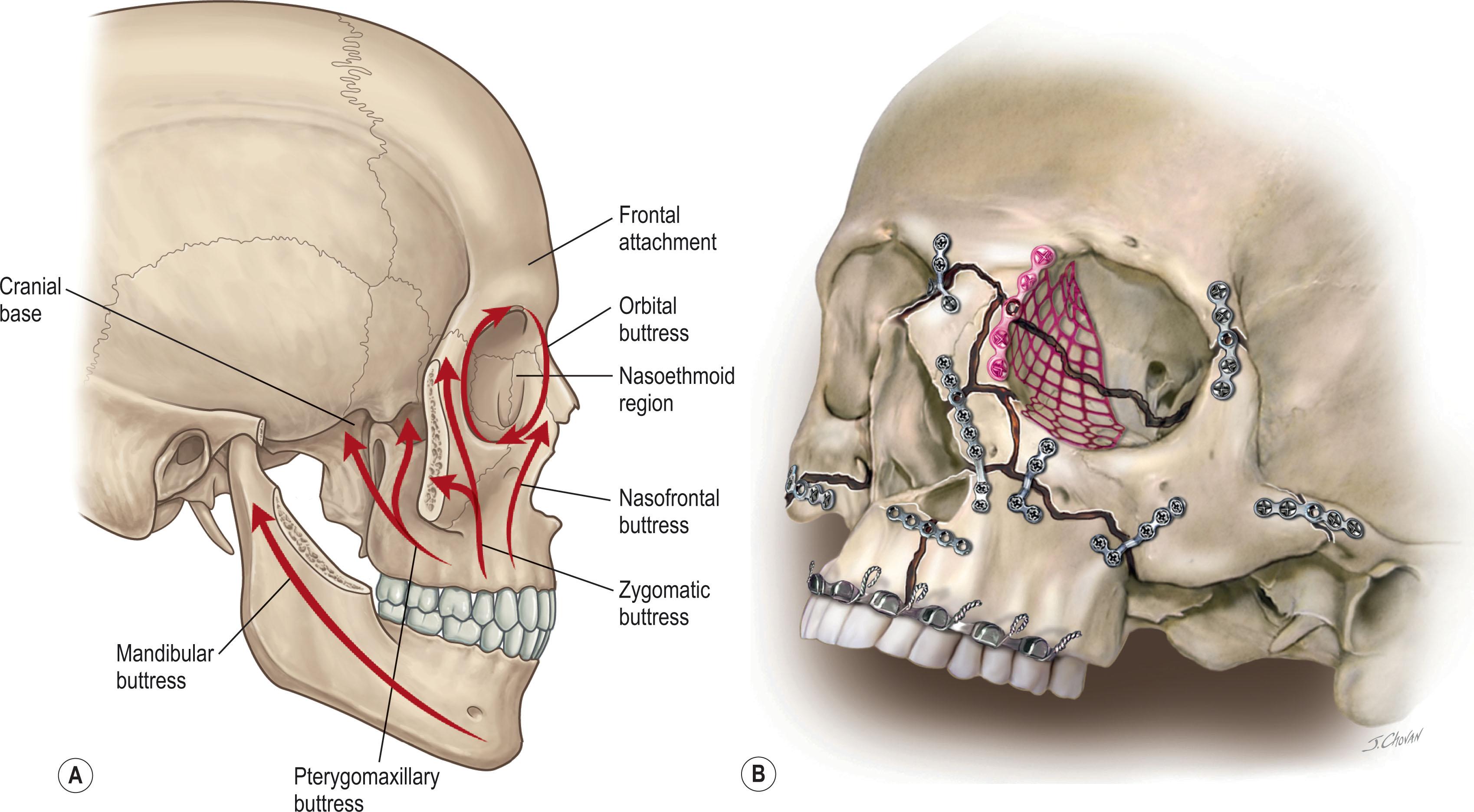 Figure 1.10, (A) The buttresses of the facial skeleton are areas where there is increased thickness of the bony skeleton. These areas act as “shock absorbers” to dissipate forces applied to the facial skeleton, decreasing the transmission to critical structures such as the globes, brain, and neck. (B) Rigid internal fixation is typically placed across the buttresses, as the bone quality here is sufficient, in most instances, to allow adequate screw purchase. When buttresses are disrupted, consideration should be given to reconstruction using autologous bone graft.