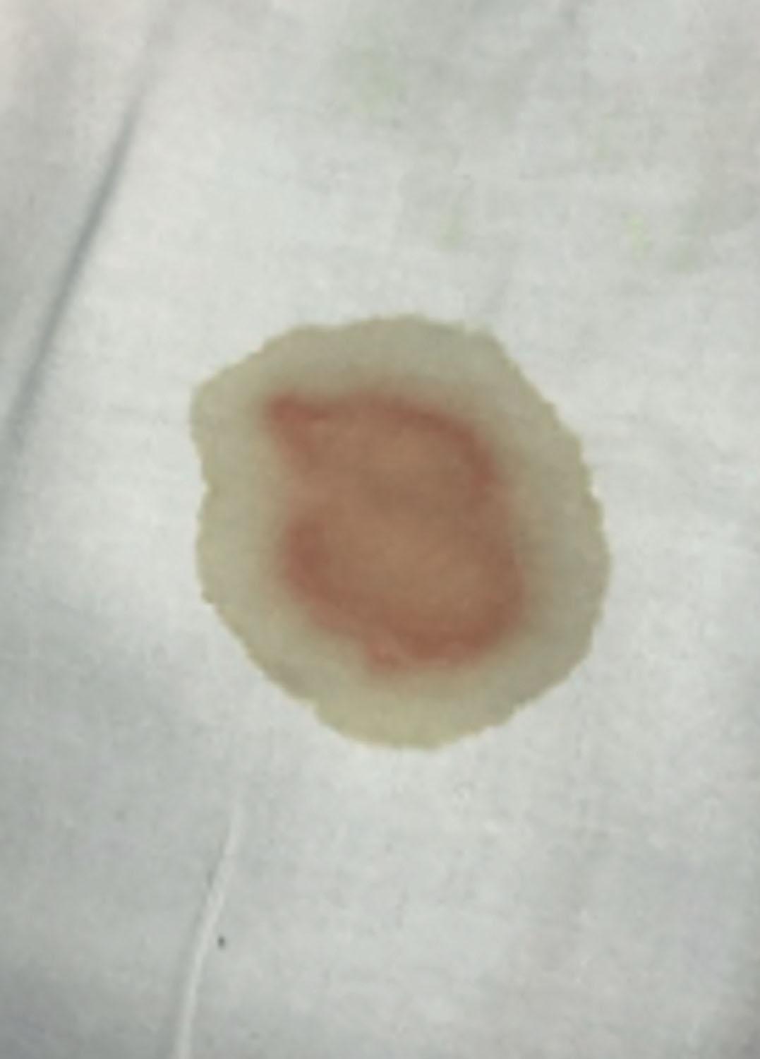 Figure 1.11, Positive “halo” test in a patient with skull base injury and cerebrospinal fluid leak. The halo sign is due to the diffusion of CSF away from the blood, forming a “halo” around the blood.