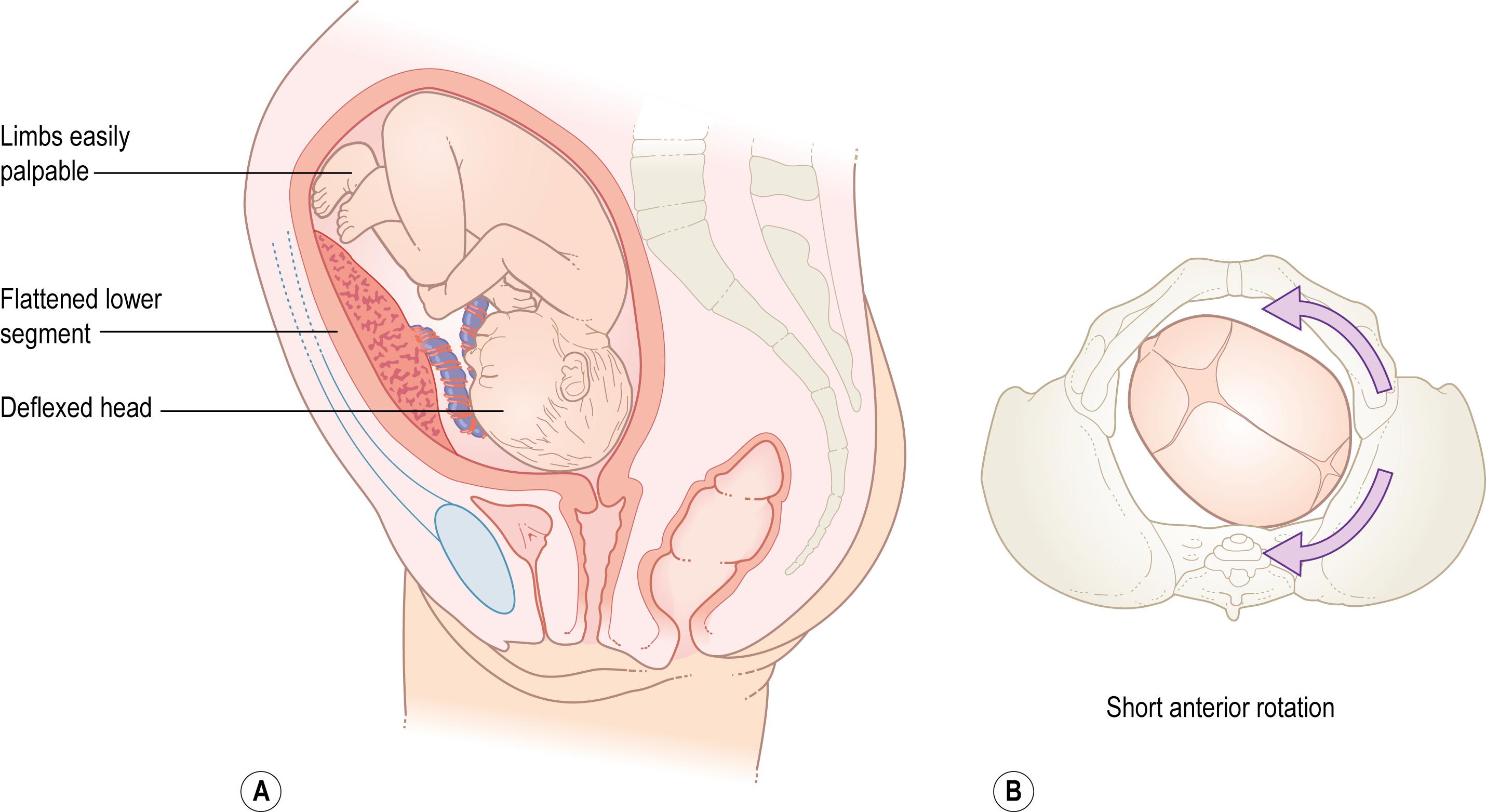 Fig. 12.7, Clinical findings in the occipitoposterior position (A); the head may rotate anteriorly or posteriorly or may arrest in the occipitoposterior position (B).