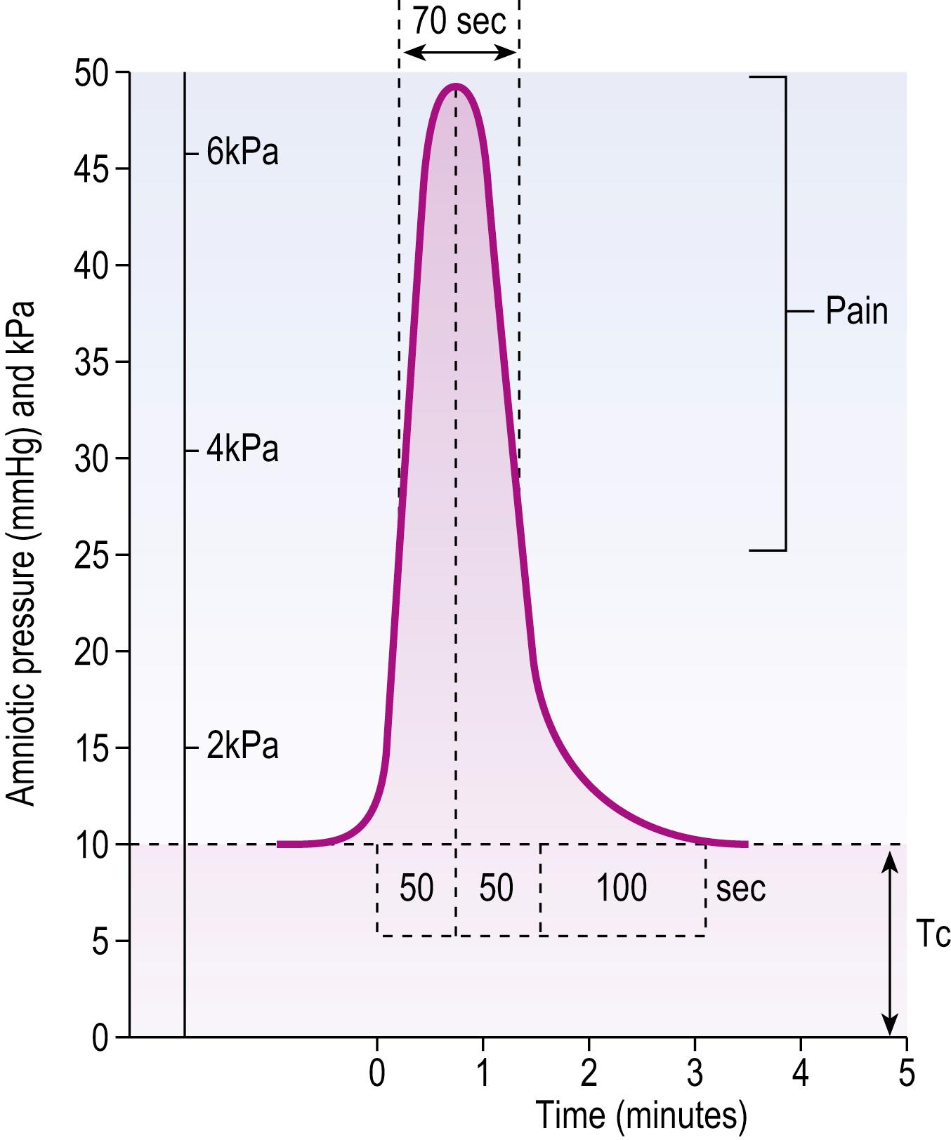 Fig. 11.1, Uterine contractions reach pressures of 50mmHg (6.5kPa) with first stage of labour. Contractions become painful when amniotic pressure exceeds 25mmHg (3.2kPa).