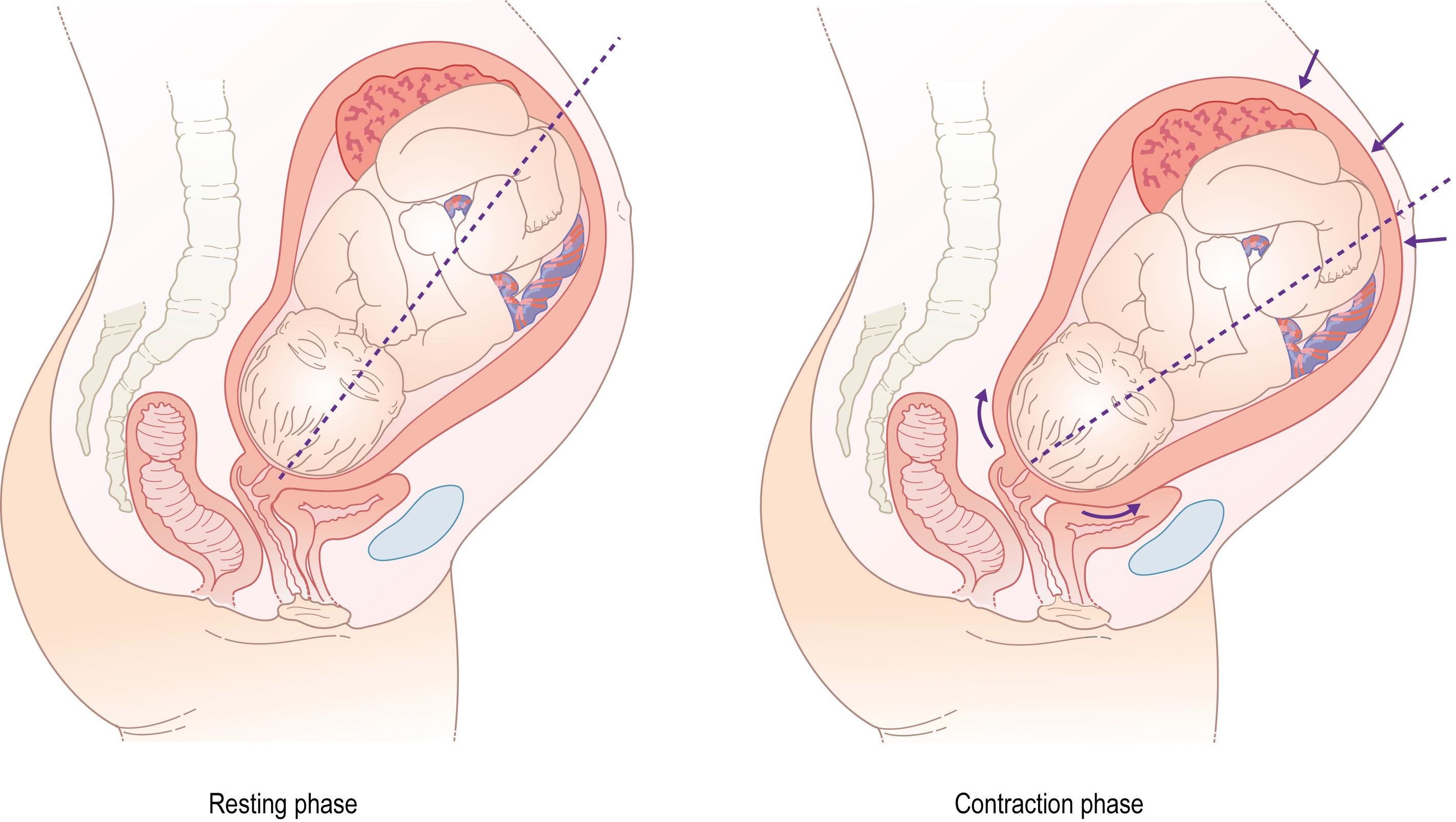 Fig. 11.3, Change in direction of the fetal and uterine axis during contractions in labour.