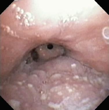 FIG. 54.2, Epiglottic collapse in association with lingual tonsillar hypertrophy.