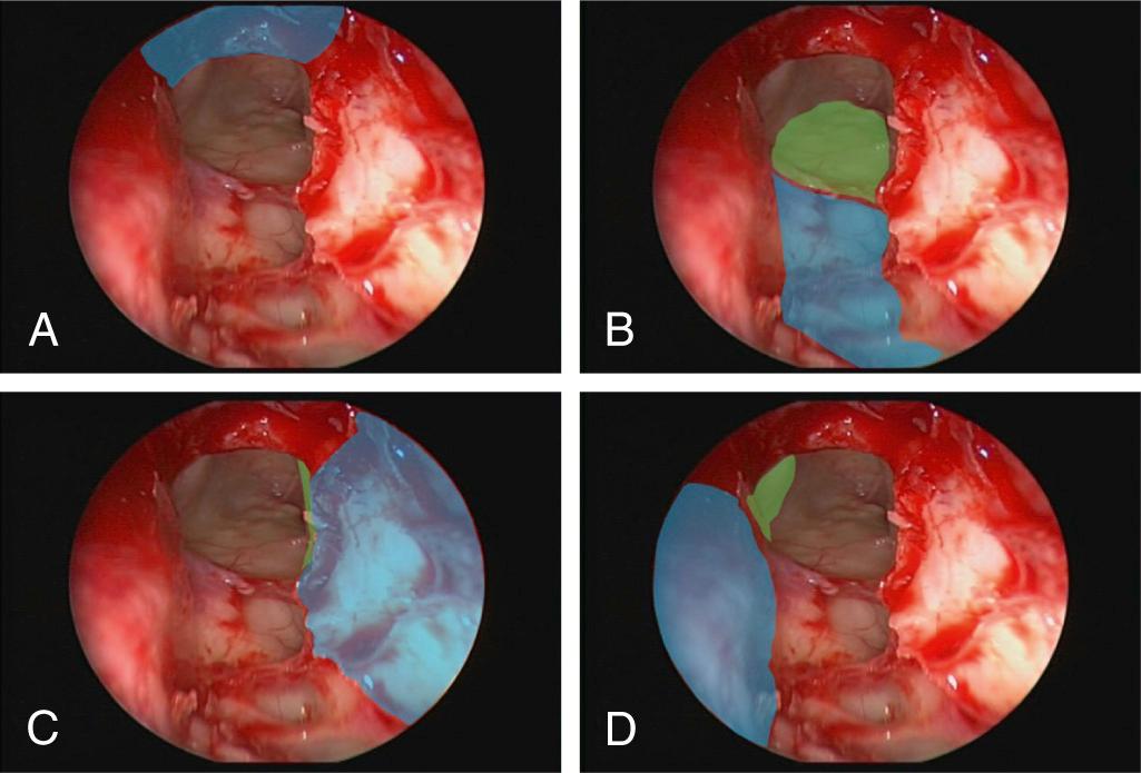 Fig. 46.1, The boundaries of the frontal recess can be defined by the front wall of the agger nasi or nasofrontal beak anteriorly (A); posterior to the frontal recess lies the ethmoid roof, and the anterior ethmoid artery runs across it (B). The lateral wall of the frontal recess is formed by the medial orbital wall/lamina papyracea and/or the agger nasi air cells (C), and the medial wall of the frontal recess is formed by the middle turbinate and lateral lamella (D), whose height is determined by the level of the cribriform plate. The boundaries of the frontal recess as should be seen at the end of Draf IIa (E).