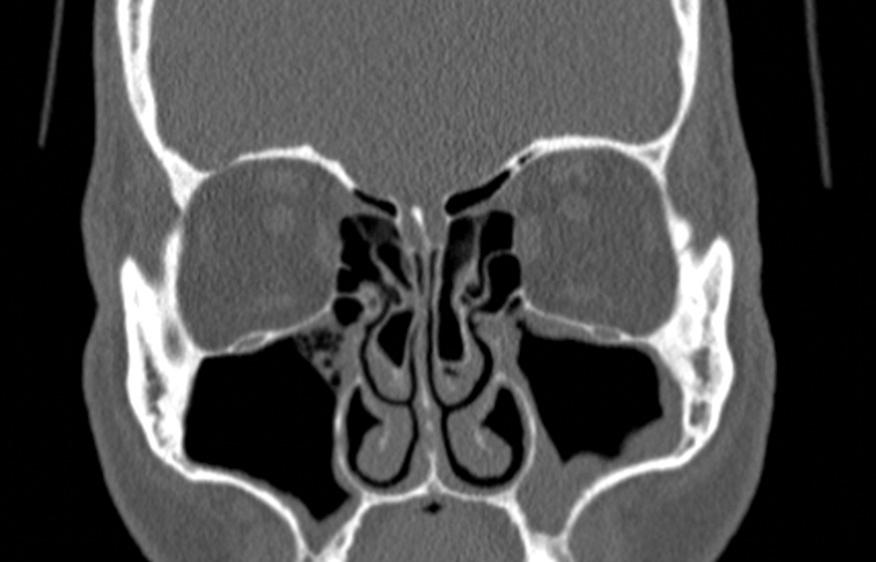 Fig. 46.2, Computed tomography scan, coronal plane, shows the anterior ethmoid artery crossing the anterior ethmoid, the so-called nipple sign.