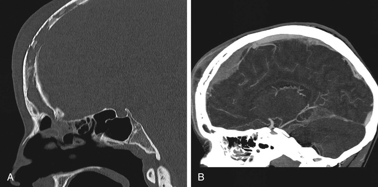 Fig. 46.3, Pott puffy tumor. (A) Computed tomography (CT) scan, sagittal view. Note the destruction of the frontal bone and swelling of the overlying soft tissues. (B) Postcontrast CT scan, venous phase, sagittal view, shows the frontal epidural abscess to be continuous with the subcutaneous abscess.