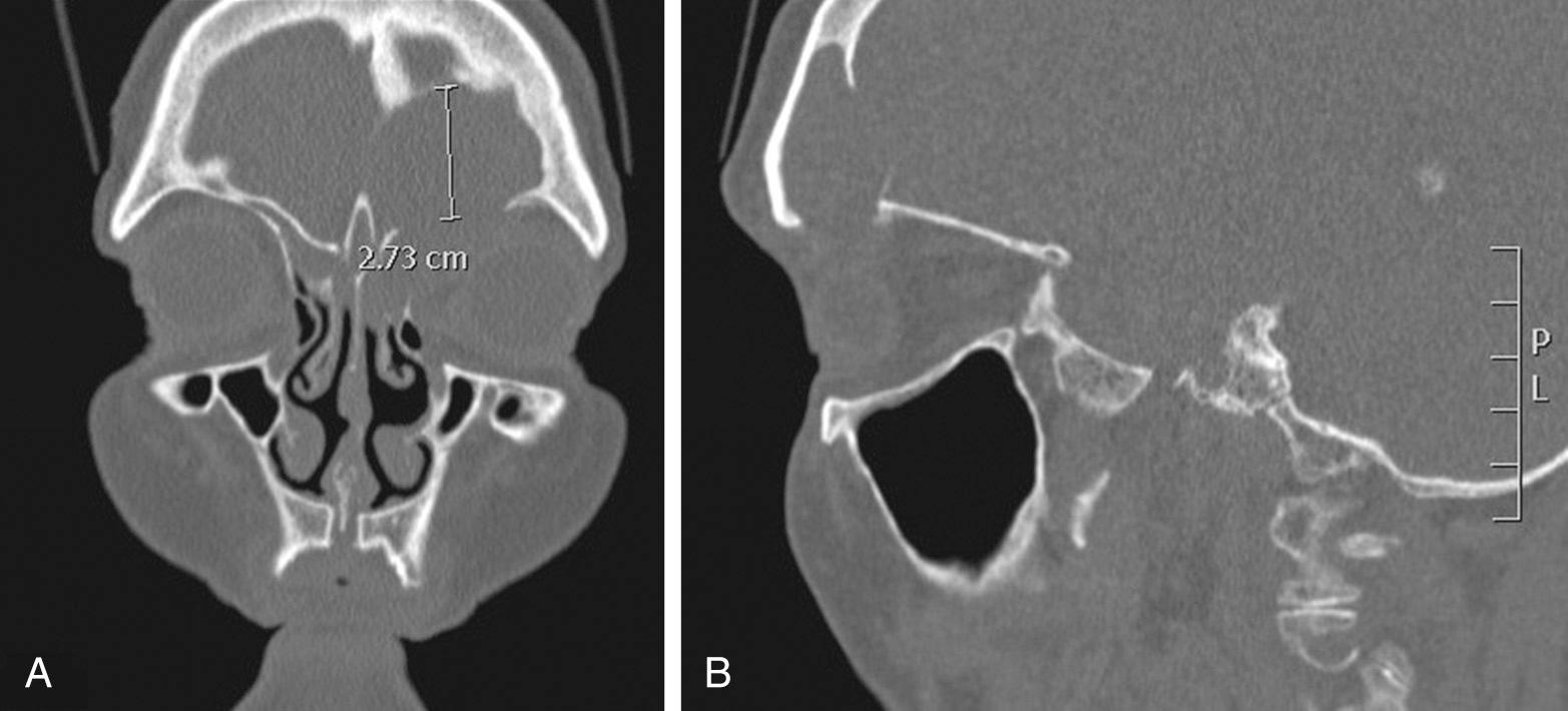 Fig. 46.4, (A) Computed tomography (CT) scan, coronal view, of a large left frontal mucocele with destruction of orbital roof and skull base. (B) CT scan, sagittal view, of a large left frontal mucocele with destruction of the orbital roof and skull base and posterior wall of the frontal sinus.