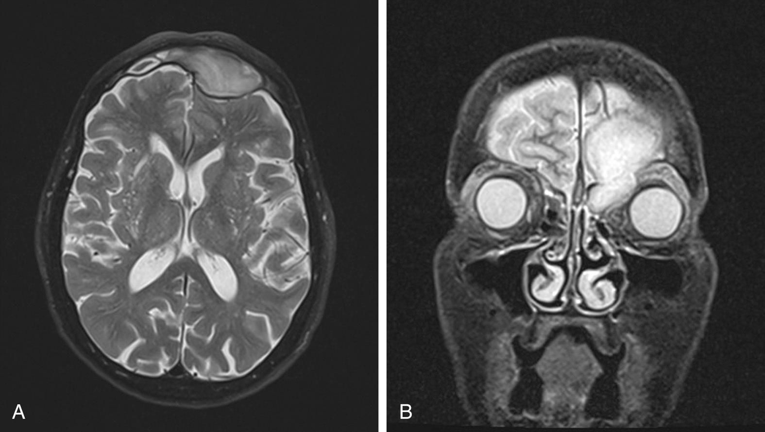 Fig. 46.5, (A) Magnetic resonance image (MRI), axial T2 with fat saturation. Hyperintense mucocele displaces the left frontal lobe, but overlying dura is intact. (B) MRI, coronal T2 with fat saturation. Hyperintense mucocele extends into the orbit and displaces the eye inferolaterally.