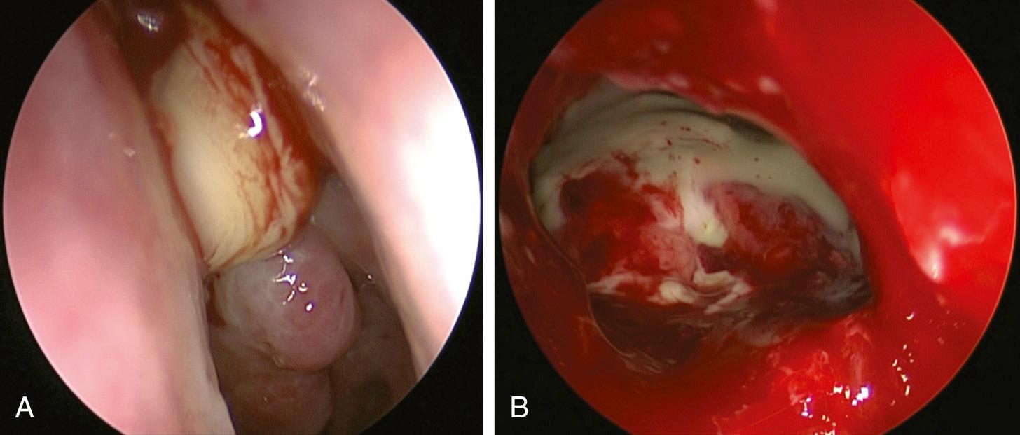 Fig. 46.6, (A) Intraoperative image of mucocele content draining from the opened frontal mucocele cavity. (B) Most of the bone usually removed by a Draf IIb procedure was destroyed by the mucocele.