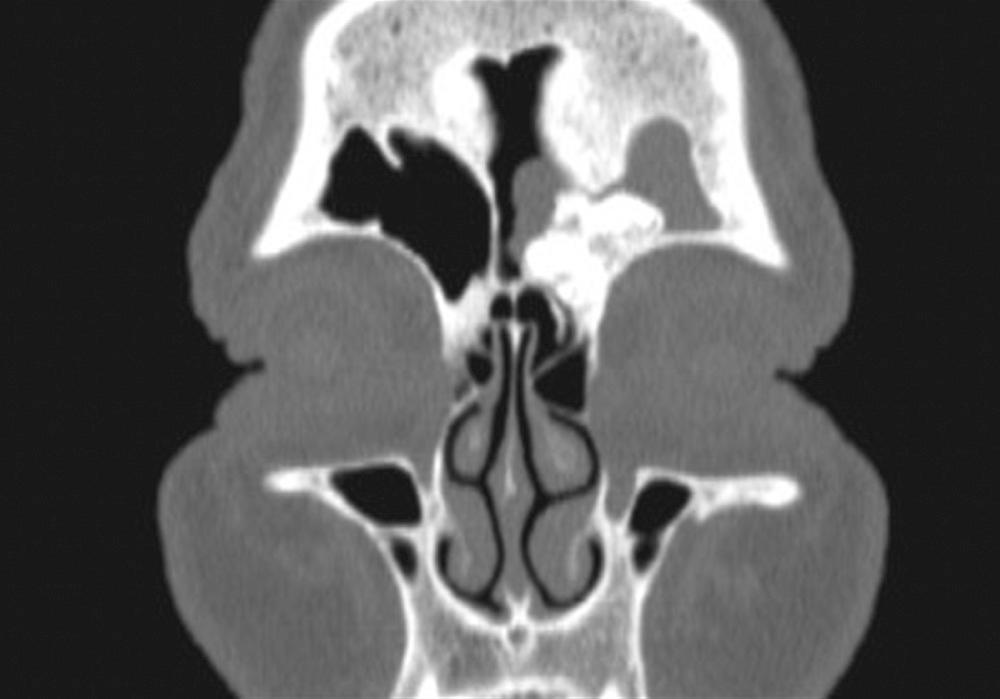 Fig. 46.7, Computed tomography scan, coronal view, of frontal osteoma causing obstruction of the frontal sinus with evidence of mucosal disease.