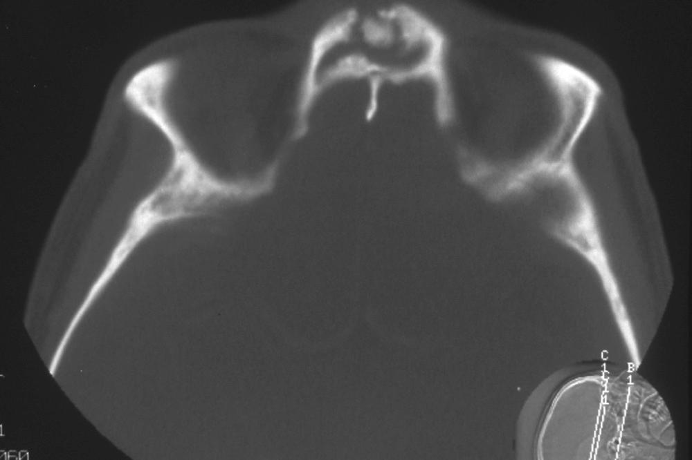 Fig. 46.8, Osteomyelitis of frontal bone with bony sequestra.