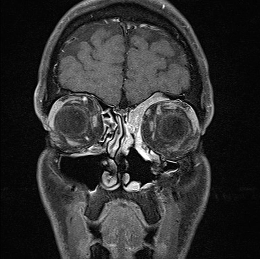 Fig. 46.9, Magnetic resonance imaging, coronal view, T1 with contrast and fat saturation. Inverted papilloma in left frontal recess. Note the different (lower) signal of the inverted papilloma compared with the hyperemic sinus mucosa.