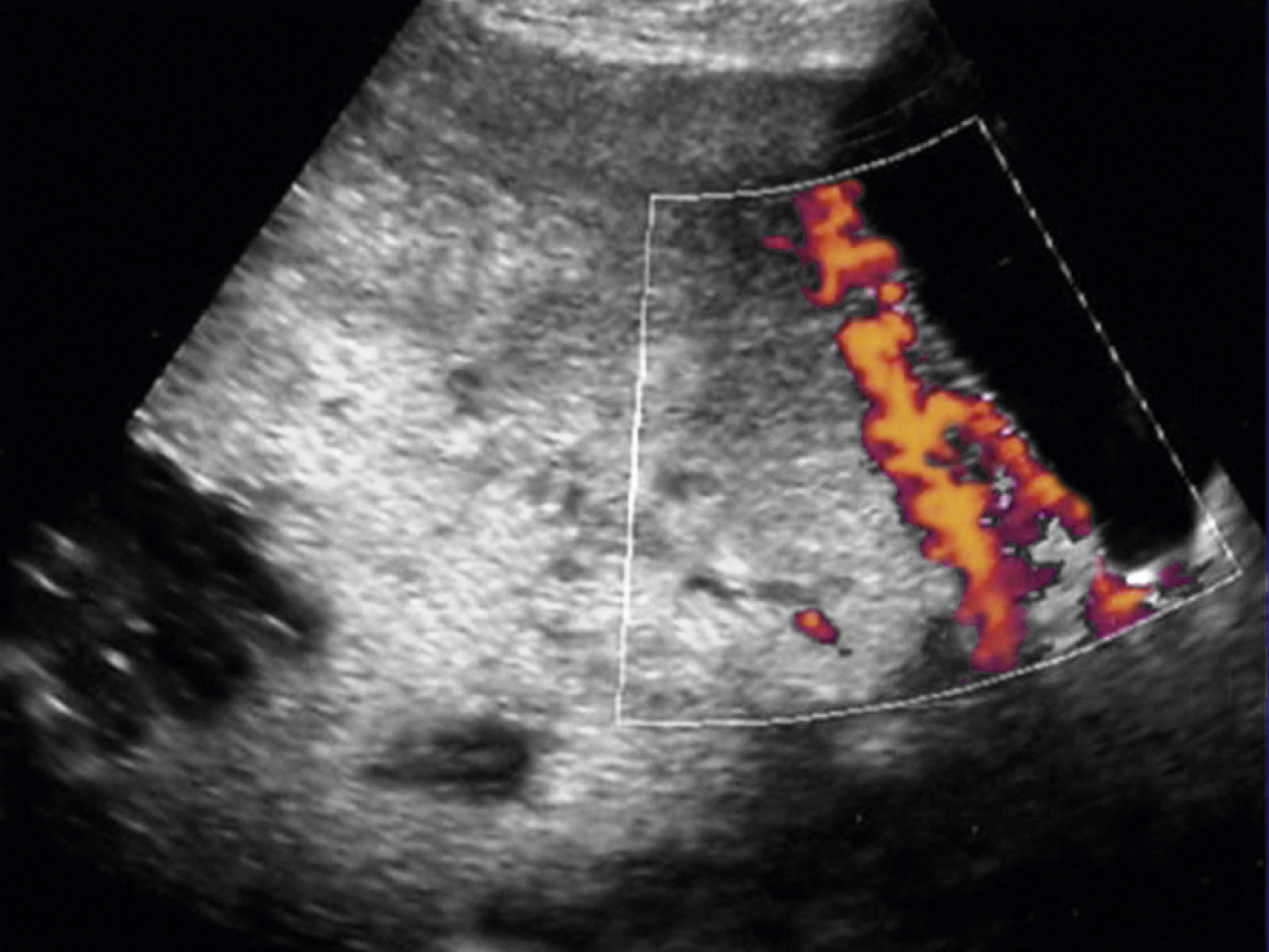 Fig. 44.1, Pelvic ultrasound with color flow Doppler showing invasive placentation. Note presence of placental vascularity in myometrium abutting and possibly penetrating serosal surface into bladder.