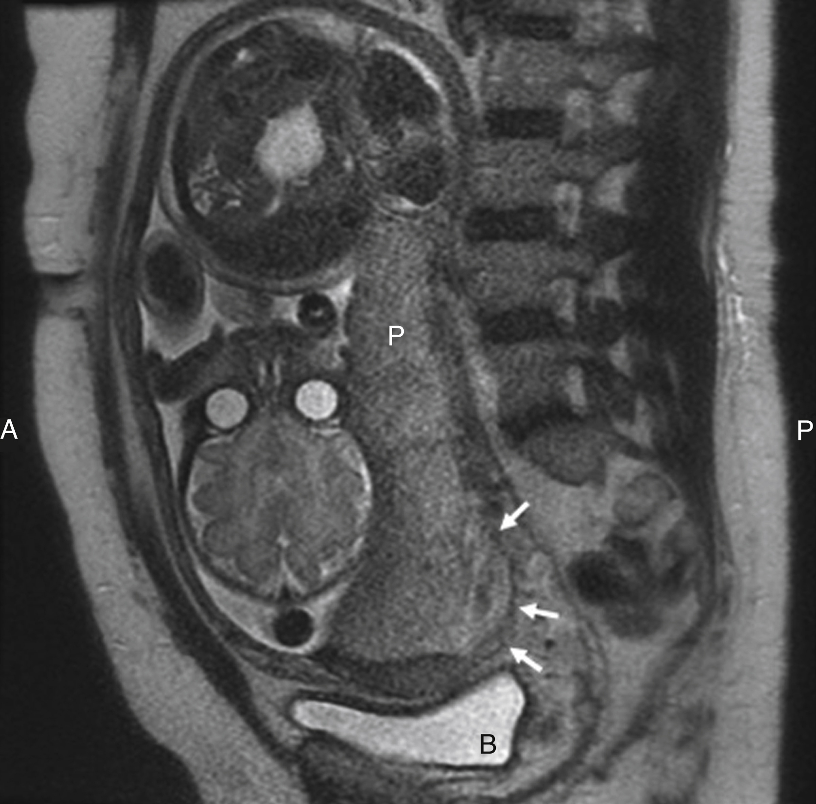 Fig. 44.2, Magnetic resonance imaging with sagittal T2 image without fat saturation of a 34-week intrauterine pregnancy with a single fetus in a cephalic position. There is a posterior placenta ( p ) with evidence of placenta percreta ( arrows ) involving the lower posterior wall of the uterus. Pathologic examination revealed placenta percreta. B , Bladder.