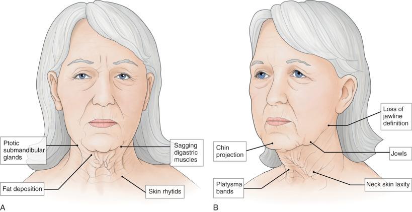 FIGURE 12.1, Aging neck features. (A) Front view. (B) Oblique view.