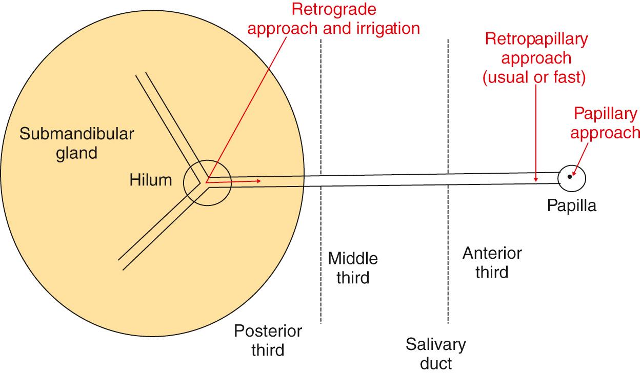 Fig. 15.1, The different approaches to the salivary ducts.