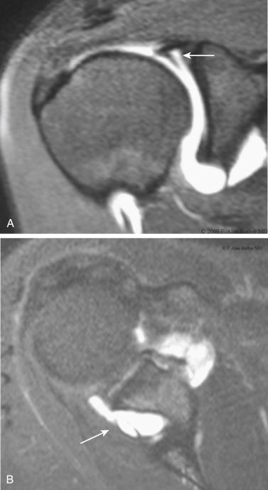 FIG. 54.2, (A) MRI diagnostic imaging with gadolinium enhances the identification of the superior labral anatomy (arrow) coronal view with a fat-suppressed T1-weighted image, intraarticular gadolinium. (B) A sublabral cyst (arrow) is often associated with a SLAP tear and sometimes with suprascapular nerve compression. It can be identified using a gadolinium-enhanced MRI study; axial view with a fat-suppressed T1-weighted image; intraarticular gadolinium.