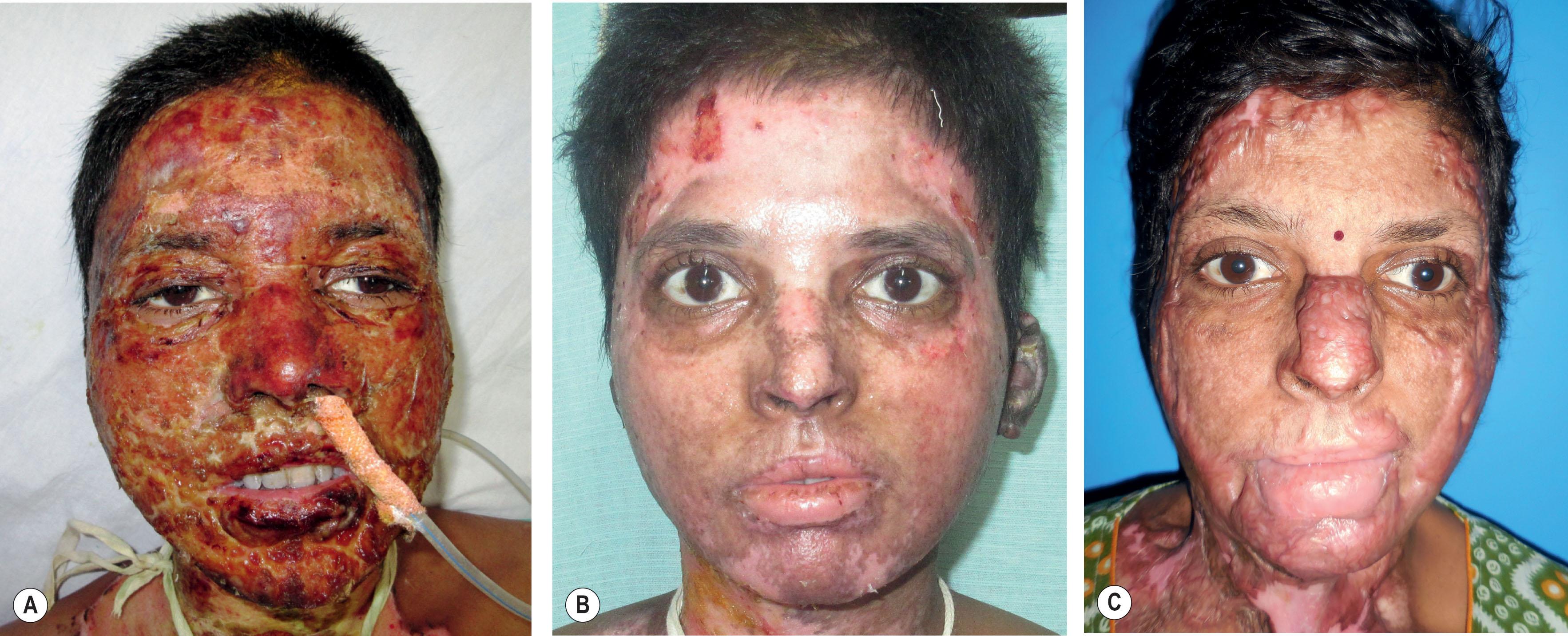 Figure 20.2, (A) Deep partial-thickness and full-thickness burns in a patient with high TBSA burns on day 10. (B) Managed by conservative treatment and no surgical intervention, healing at 4 weeks. (C) Hypertrophic scarring at 4 months.