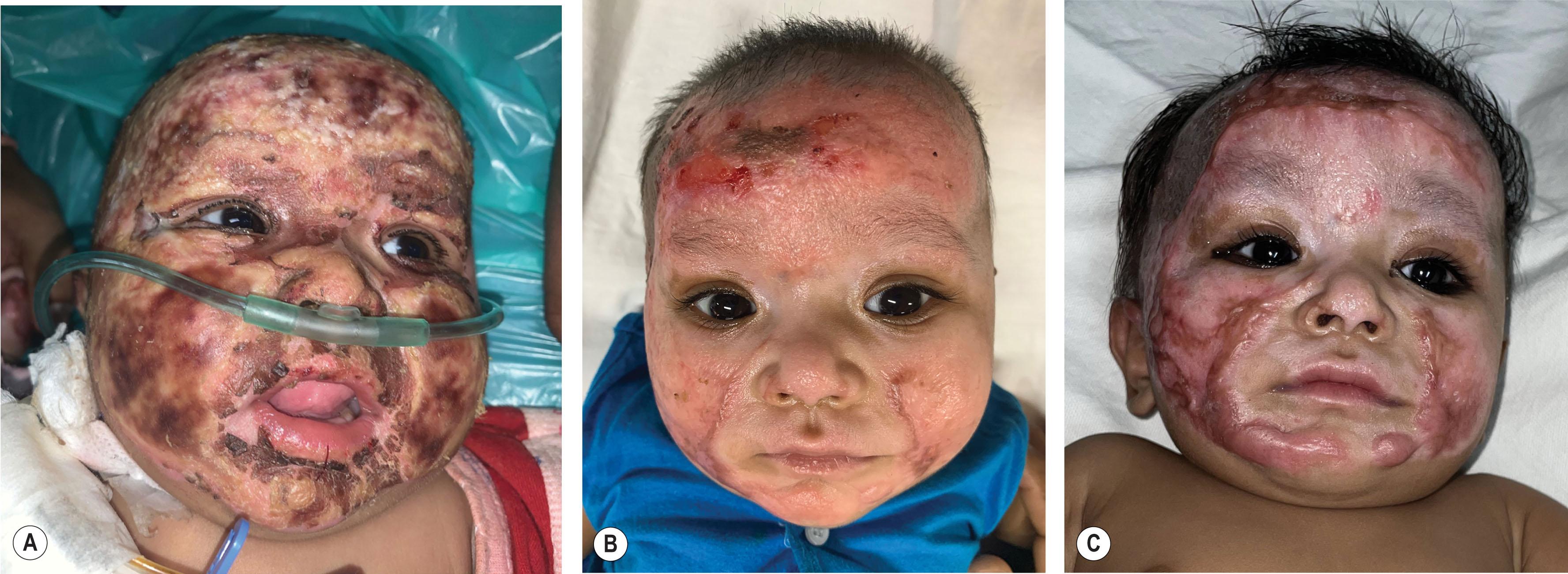 Figure 20.3, (A) 35% mixed flame burns in a 4-month-old child – at 5 days on presentation to us from another facility. He was managed with conservative management and later grafting. (B) At 3 months post-burn. (C) At 6 months post-burn.