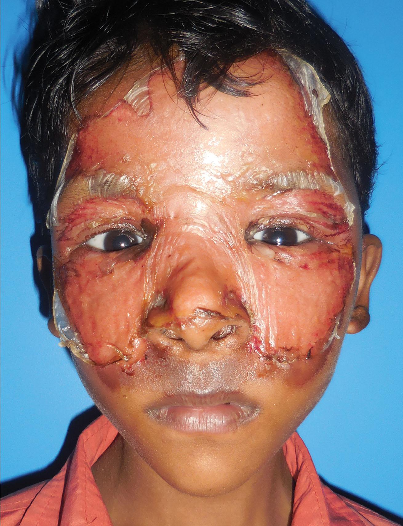 Figure 20.4, 7-year-old child with facial burns due to fire crackers. Collagen sheets have been applied.